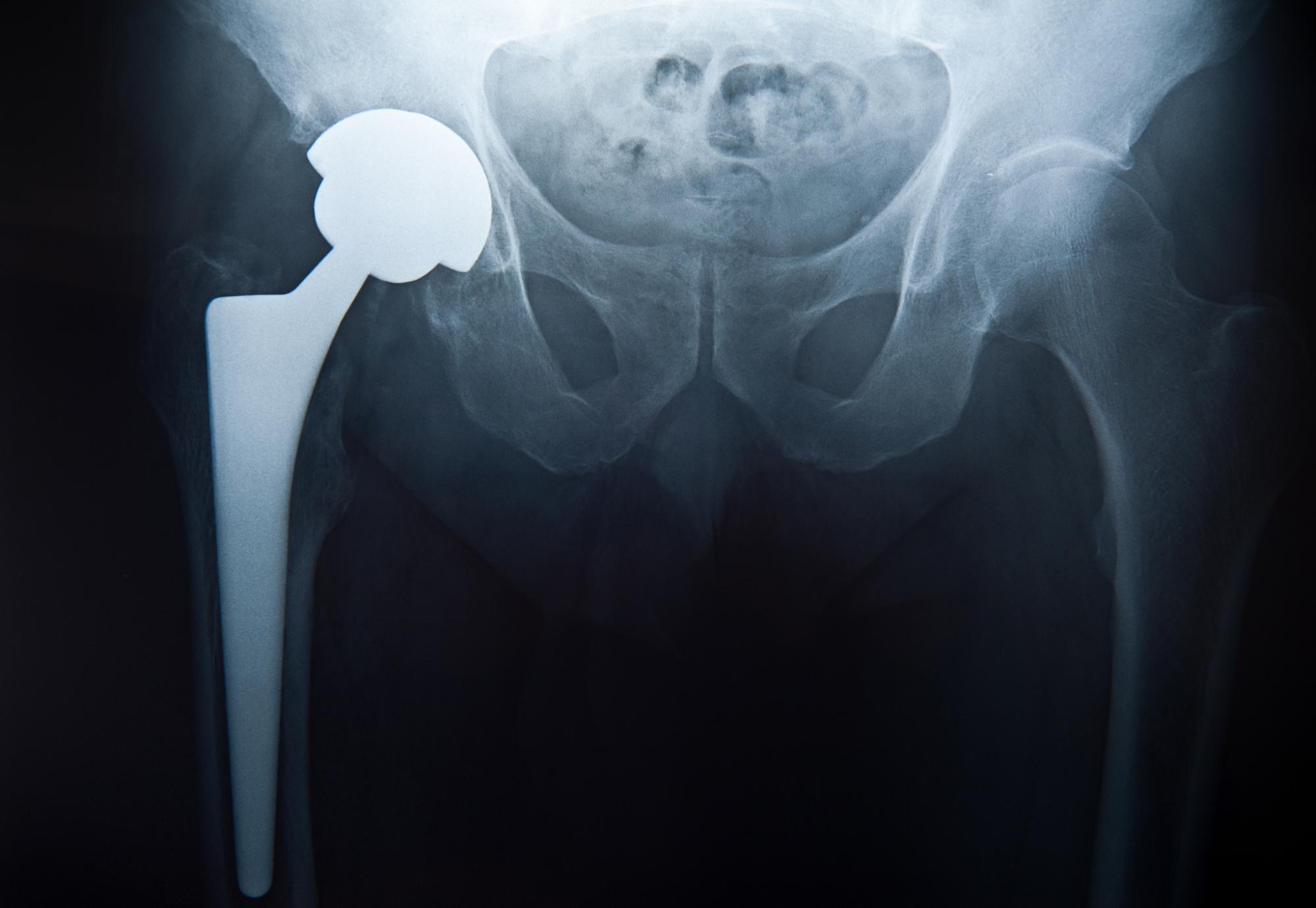 Hip replacement x-ray
