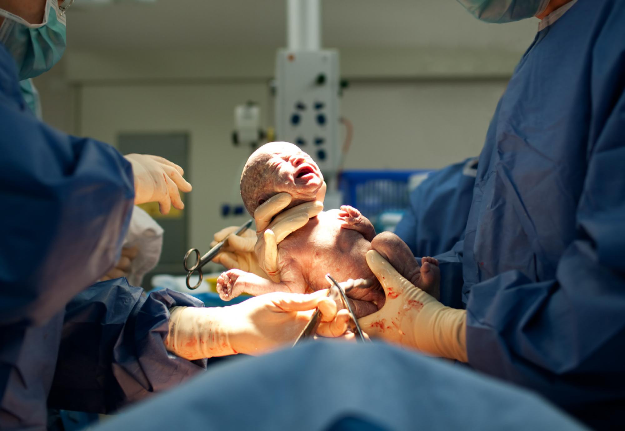 baby being born through ceasarean