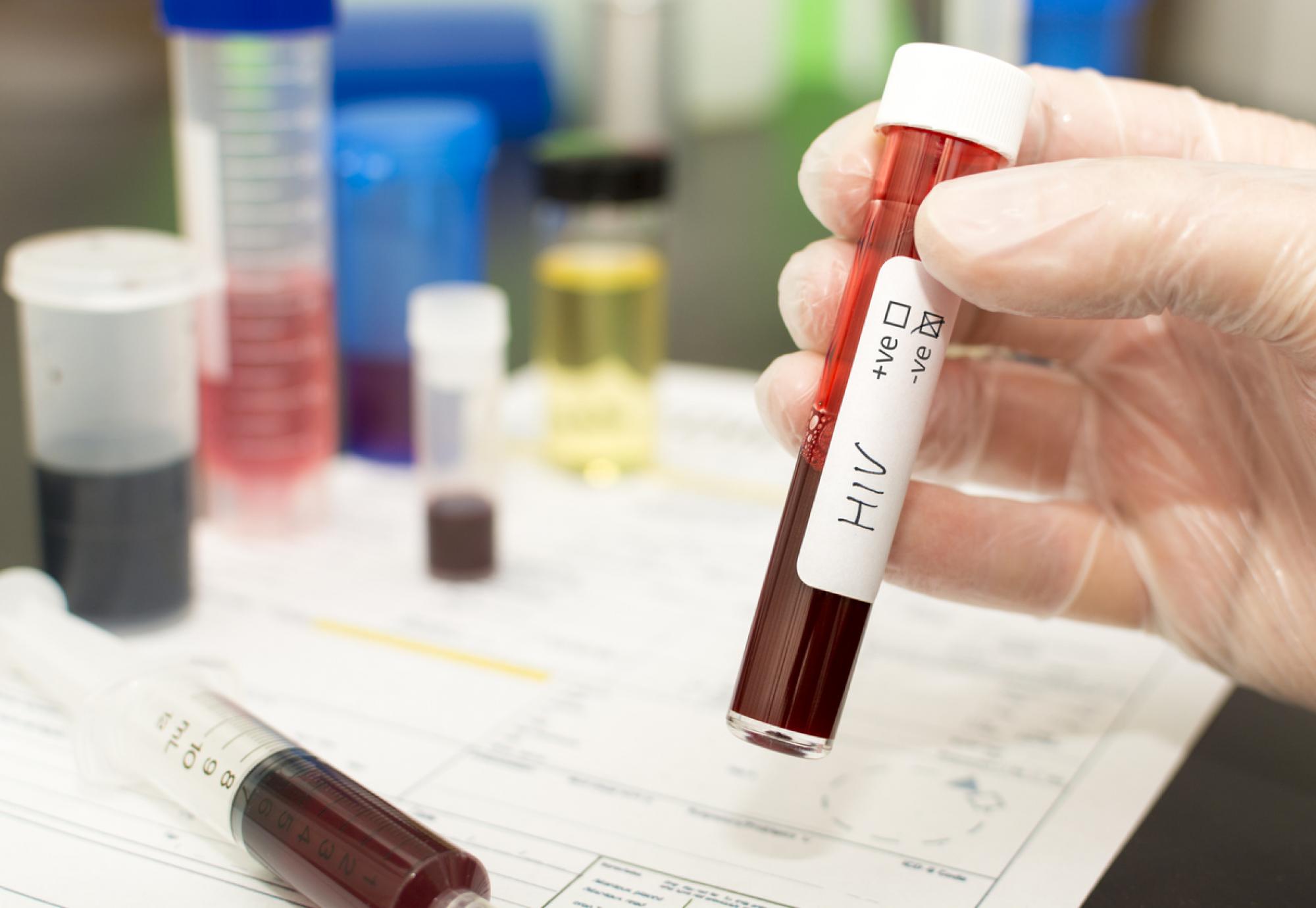 HIV blood test
