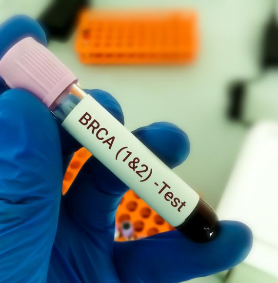 BRCA gene test for cancer