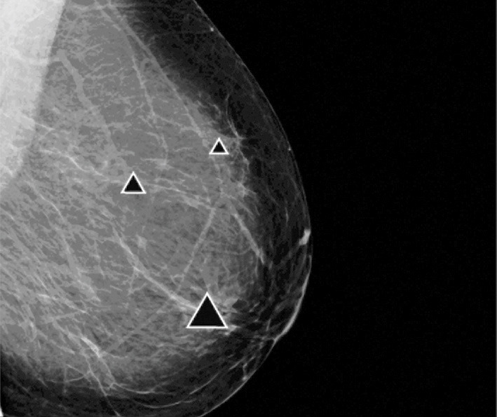 Areas of dense breast highlighted with triangles