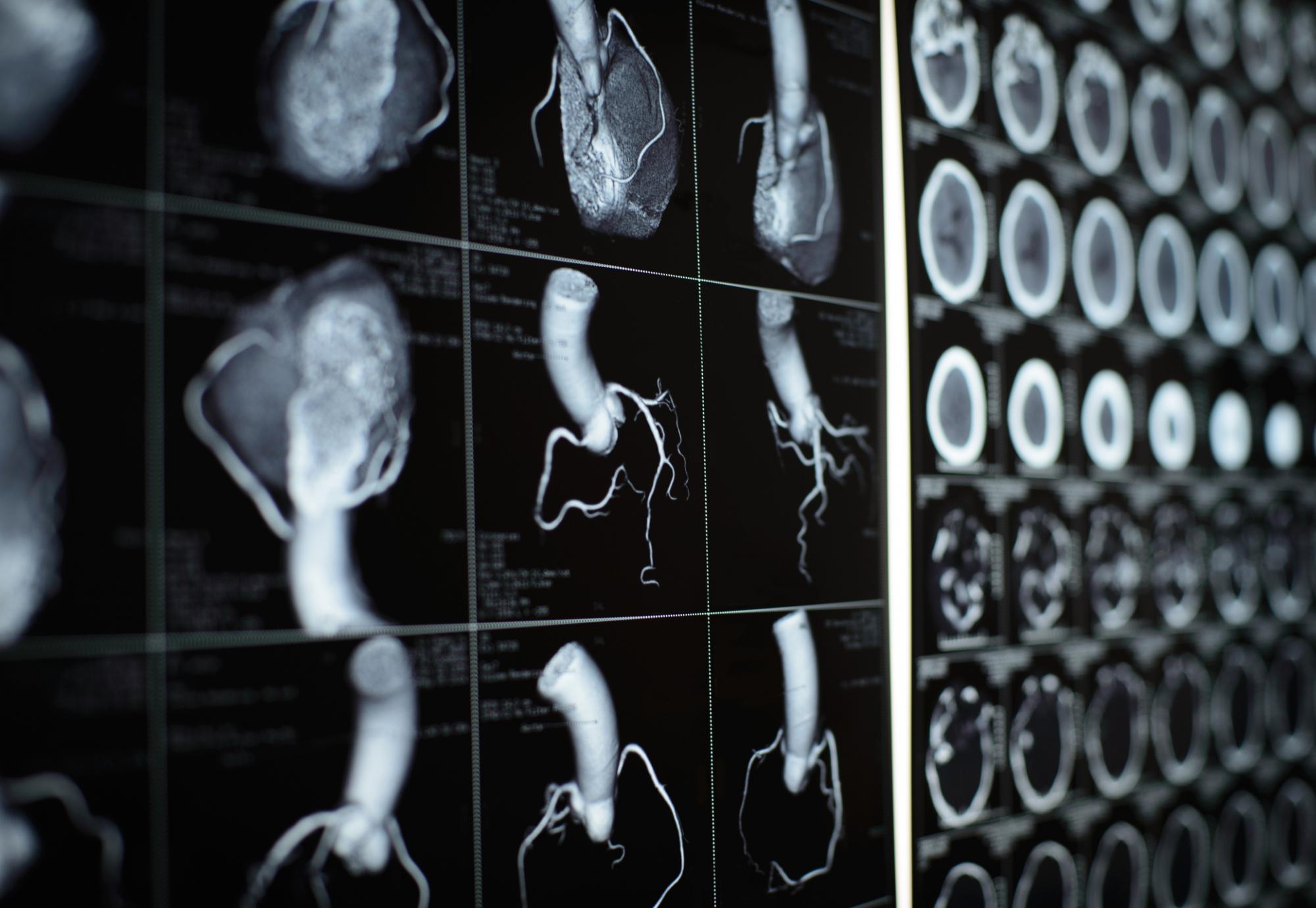 Cardiac CT scan