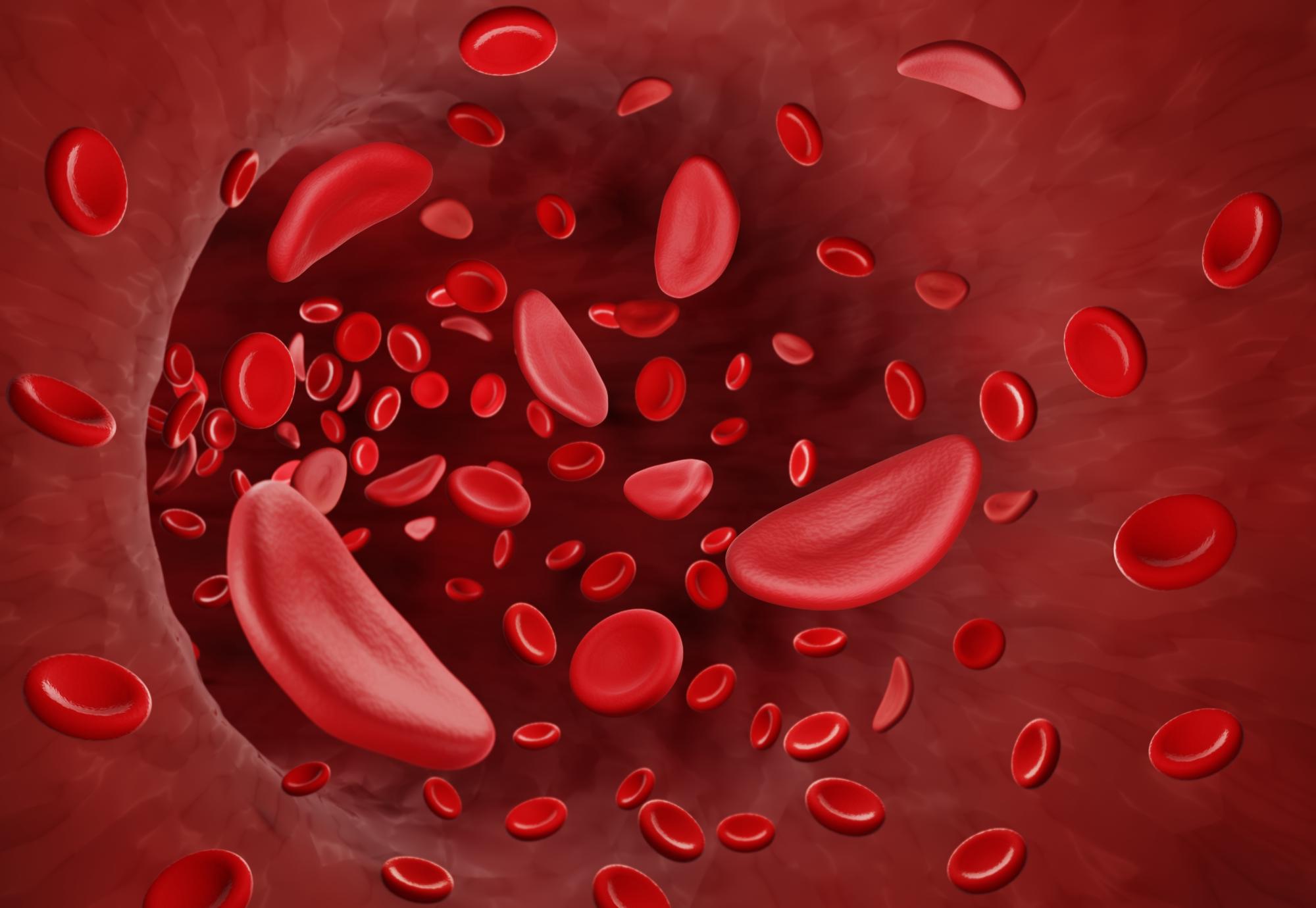 Artist illustration of sickle cell disease