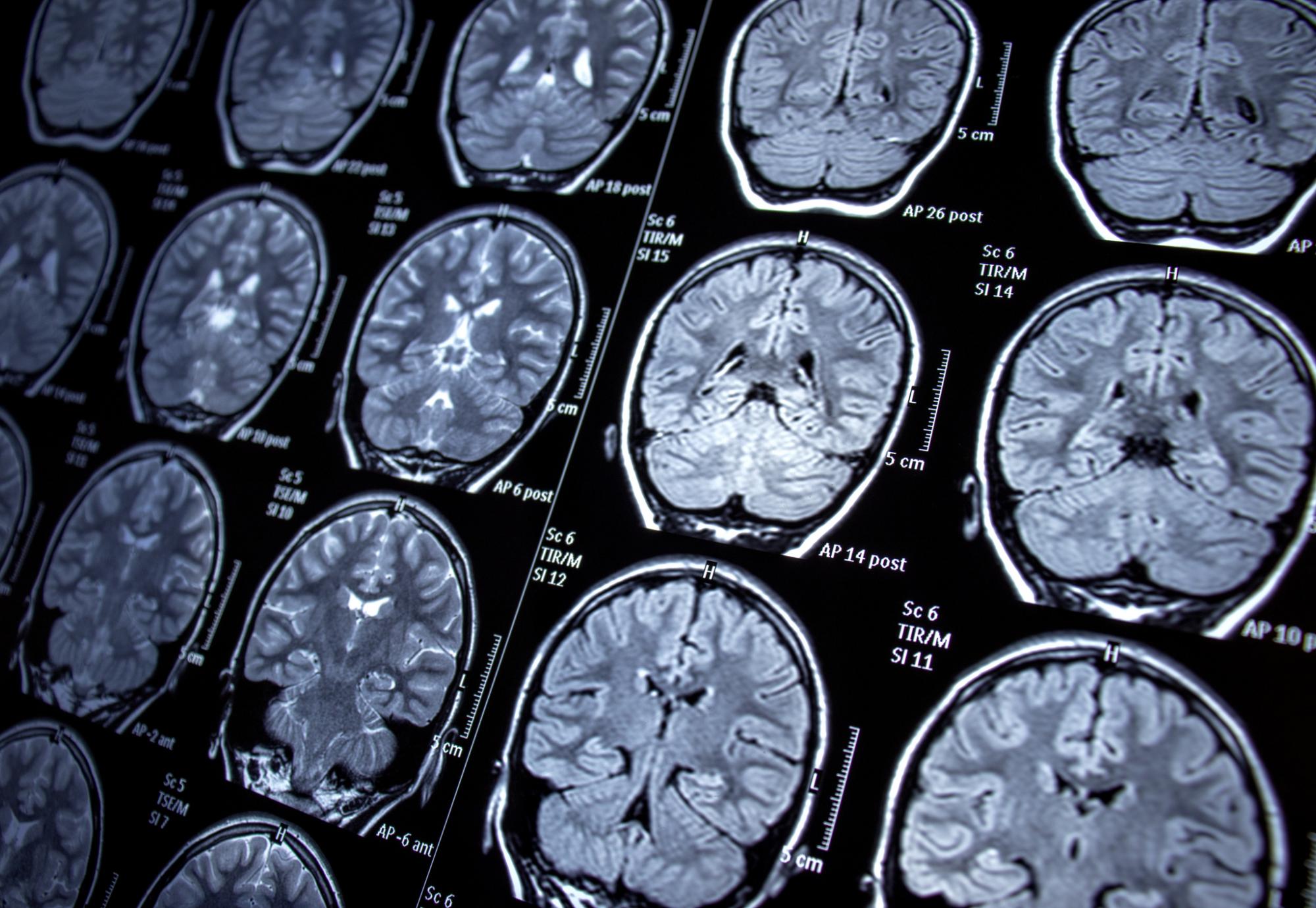 brain scans 
