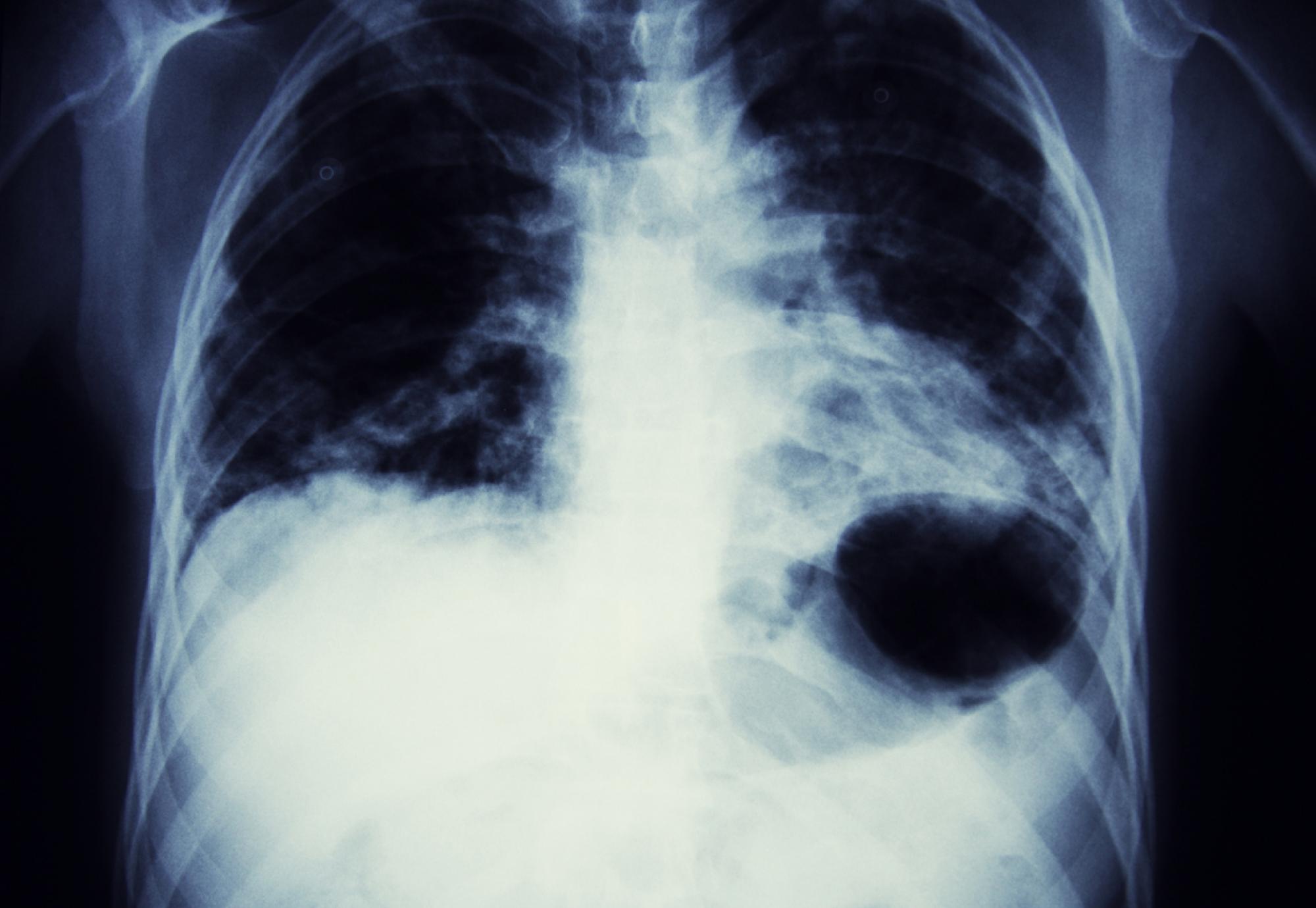 lung scan