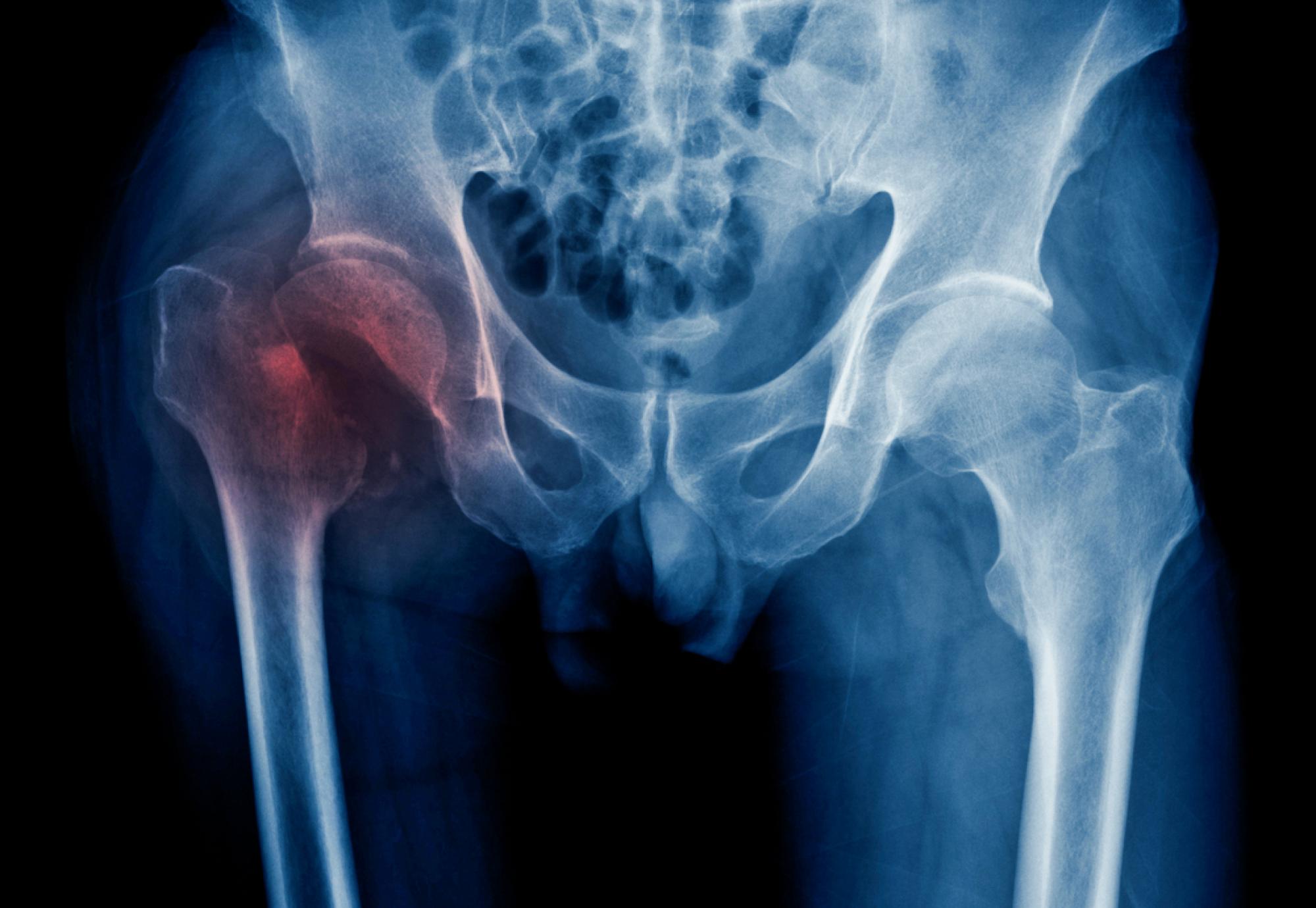 Hip fracture x-ray