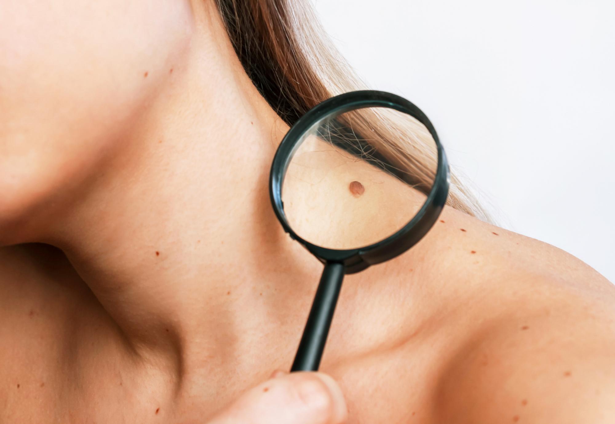 Mole on a woman's neck being magnified