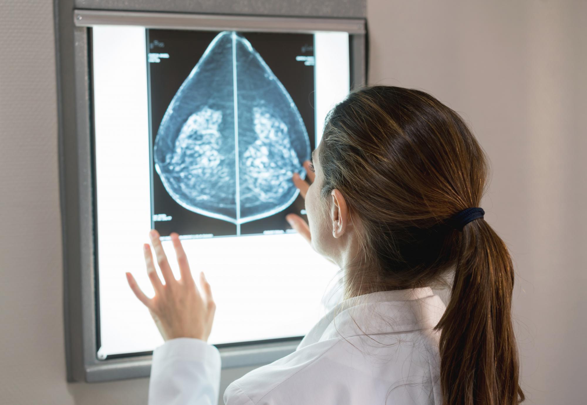 Mammography scanning  - Credit Istock 