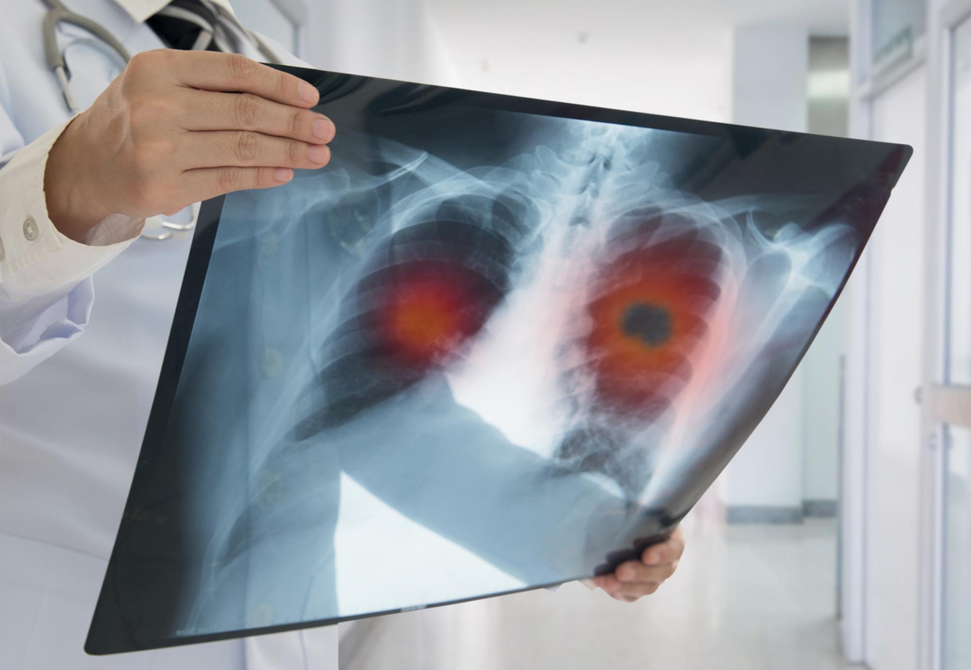 X-ray of lung cancer