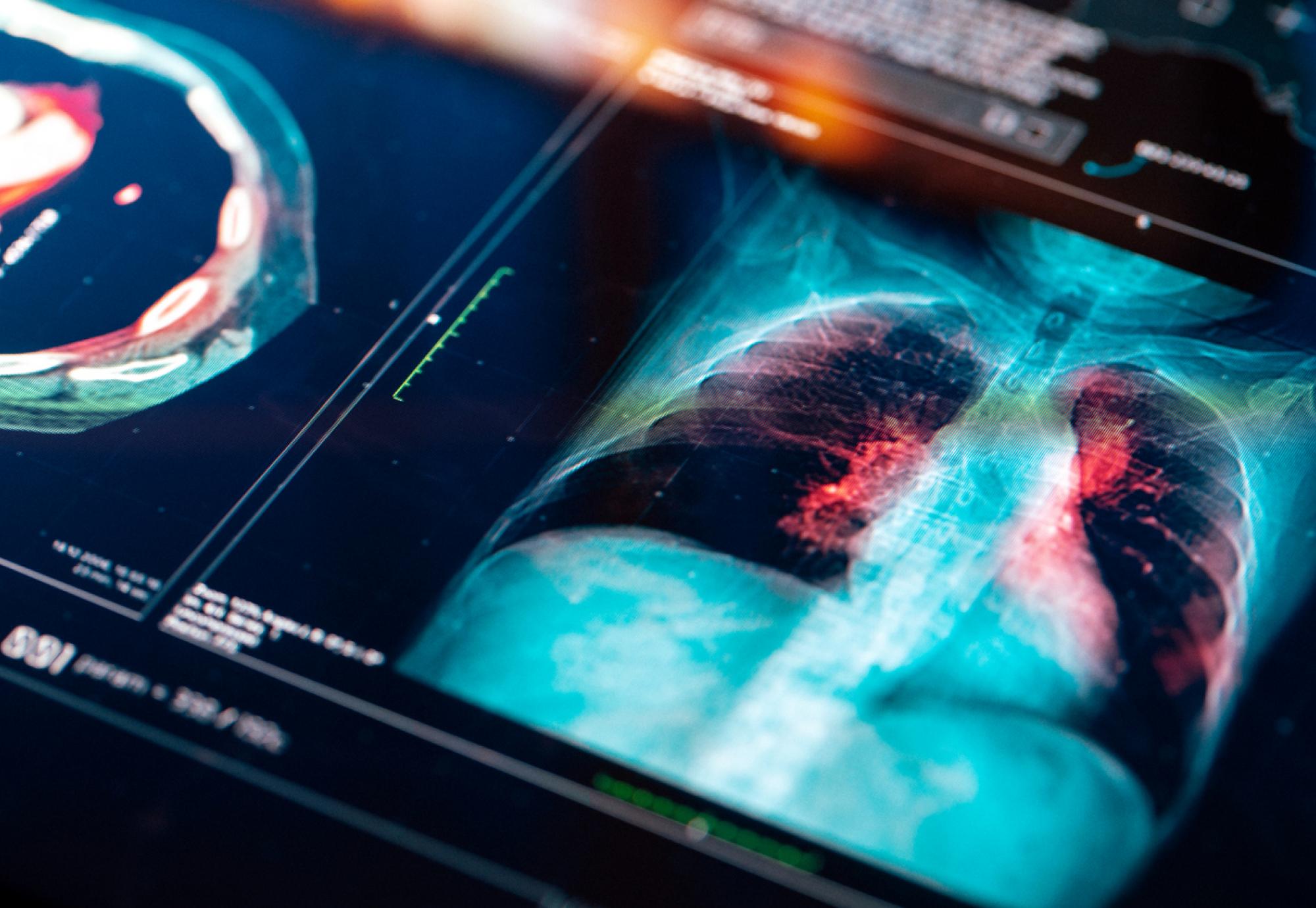 Lung cancer diagnostics