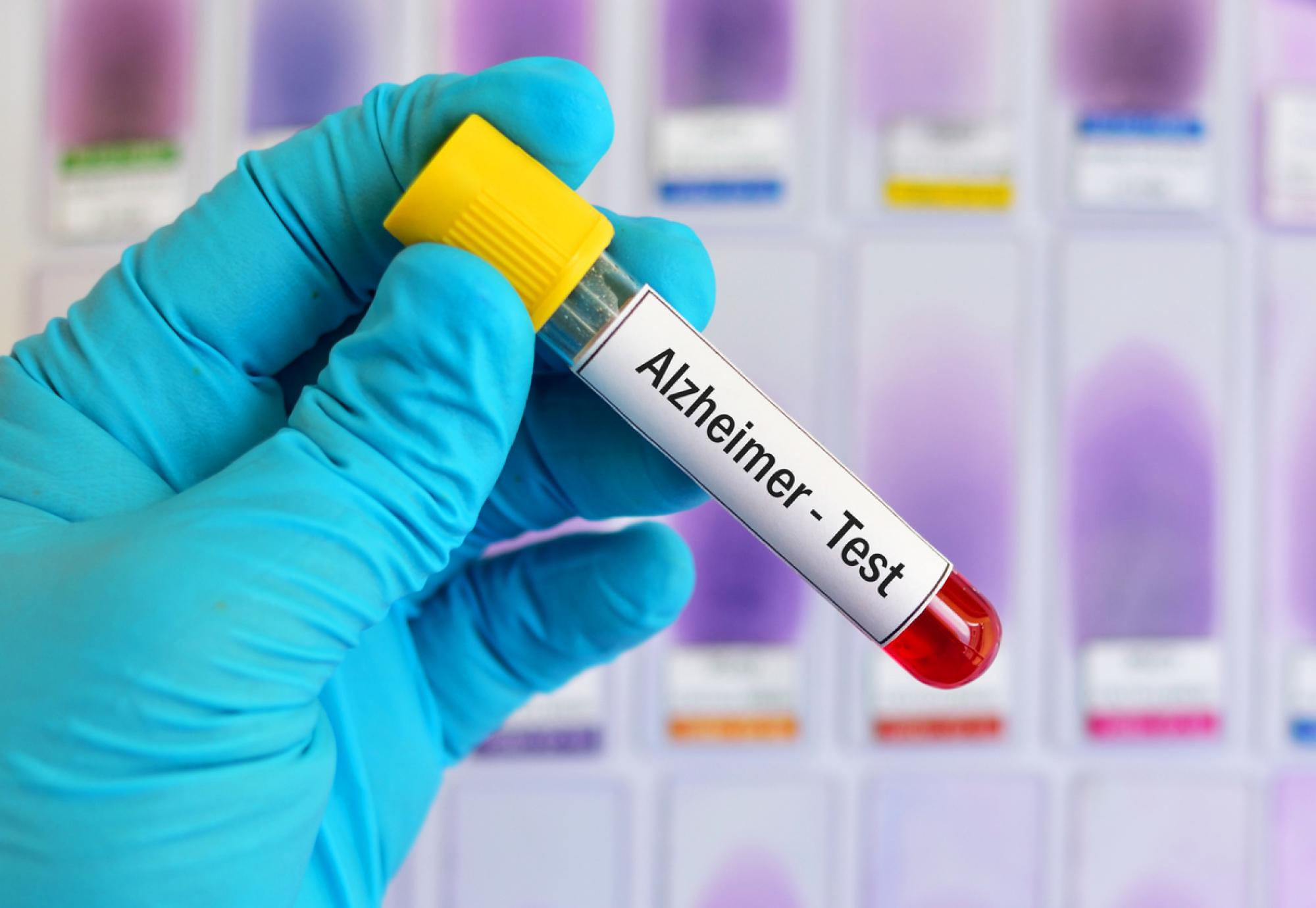 Blood test for Alzheimer's disease