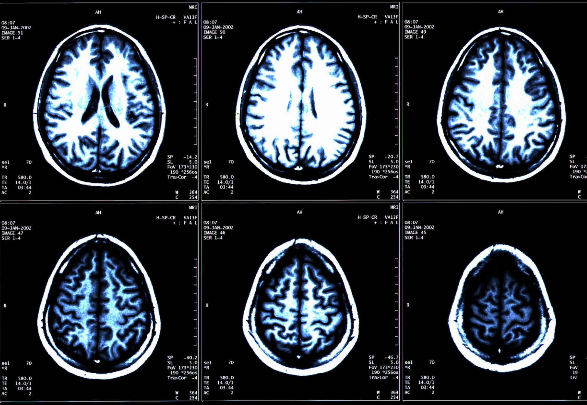 Multiple sclerosis