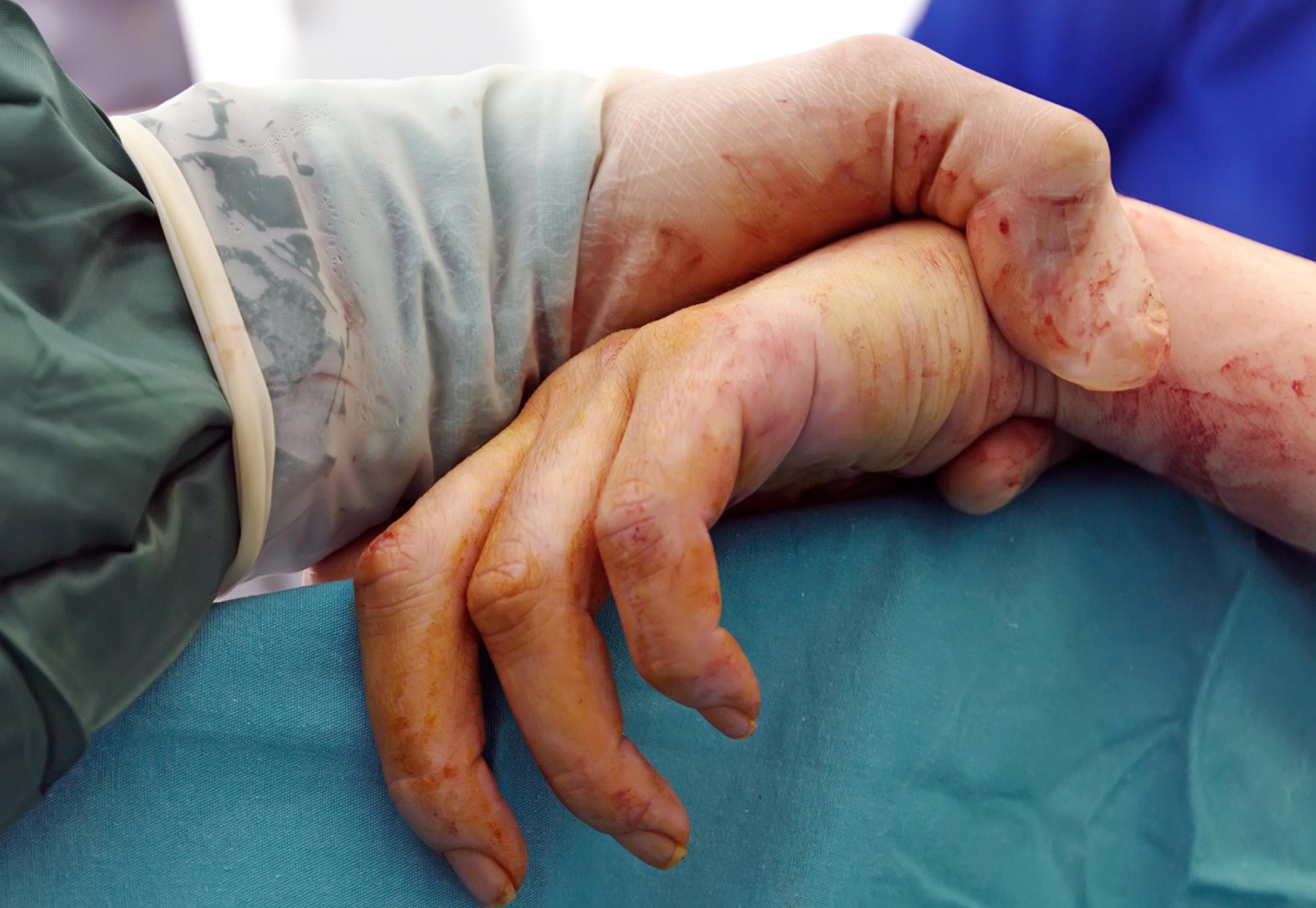 Organ transplant