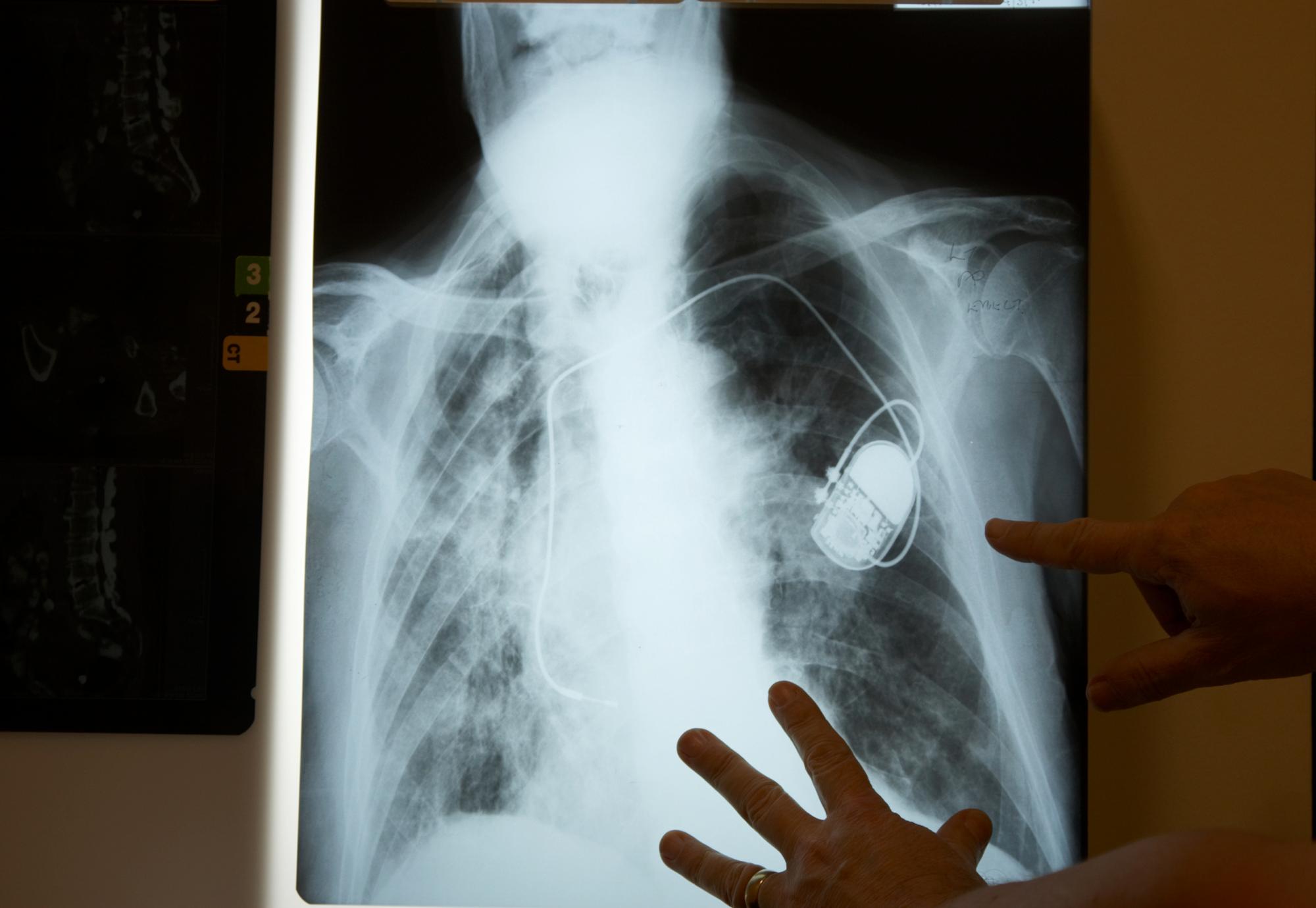 Xray of a pacemaker