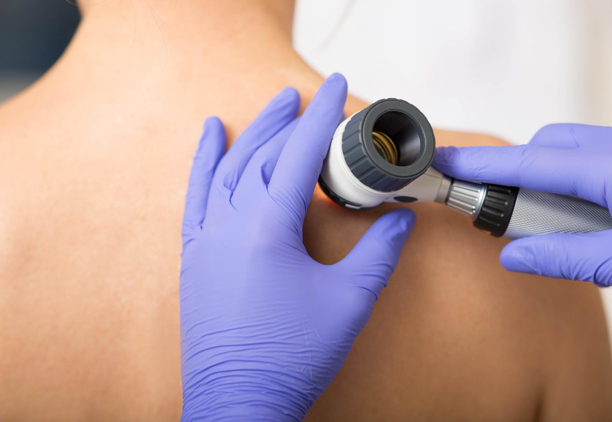Dermatologist Inspecting patient skin moles