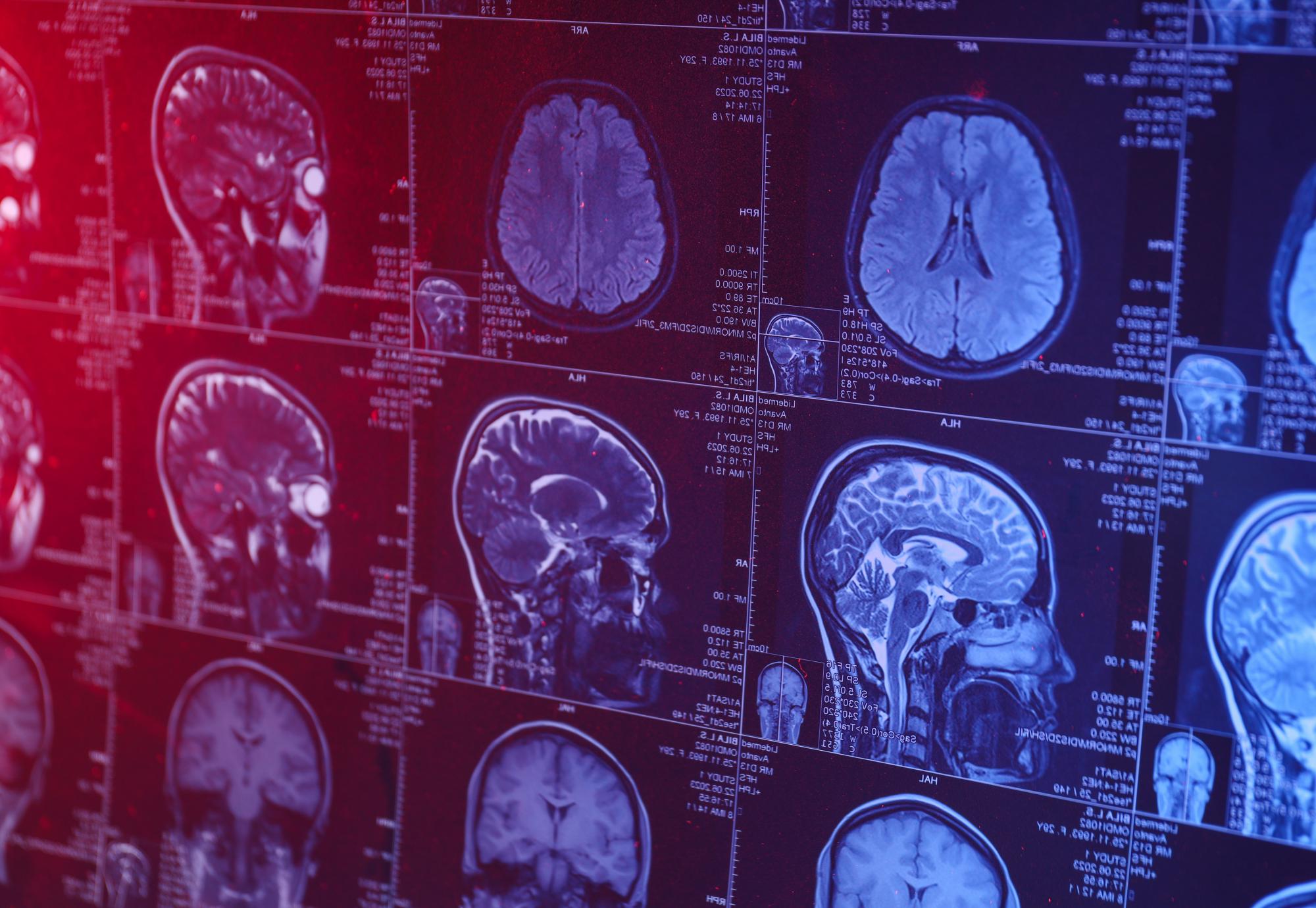 MRI scan of brain