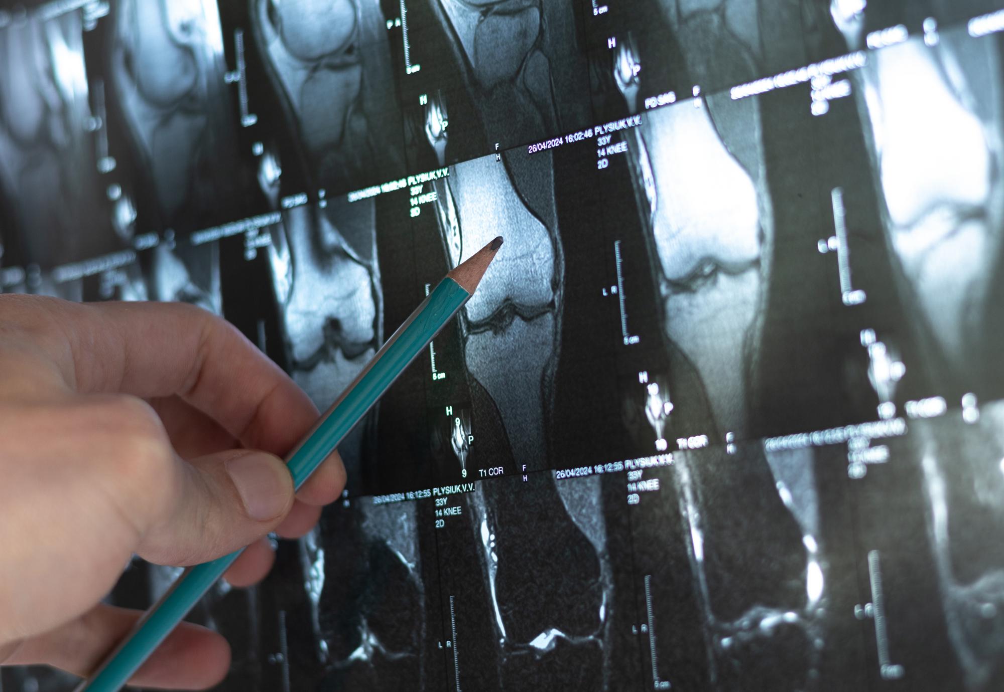 Doctor examining bone tumour