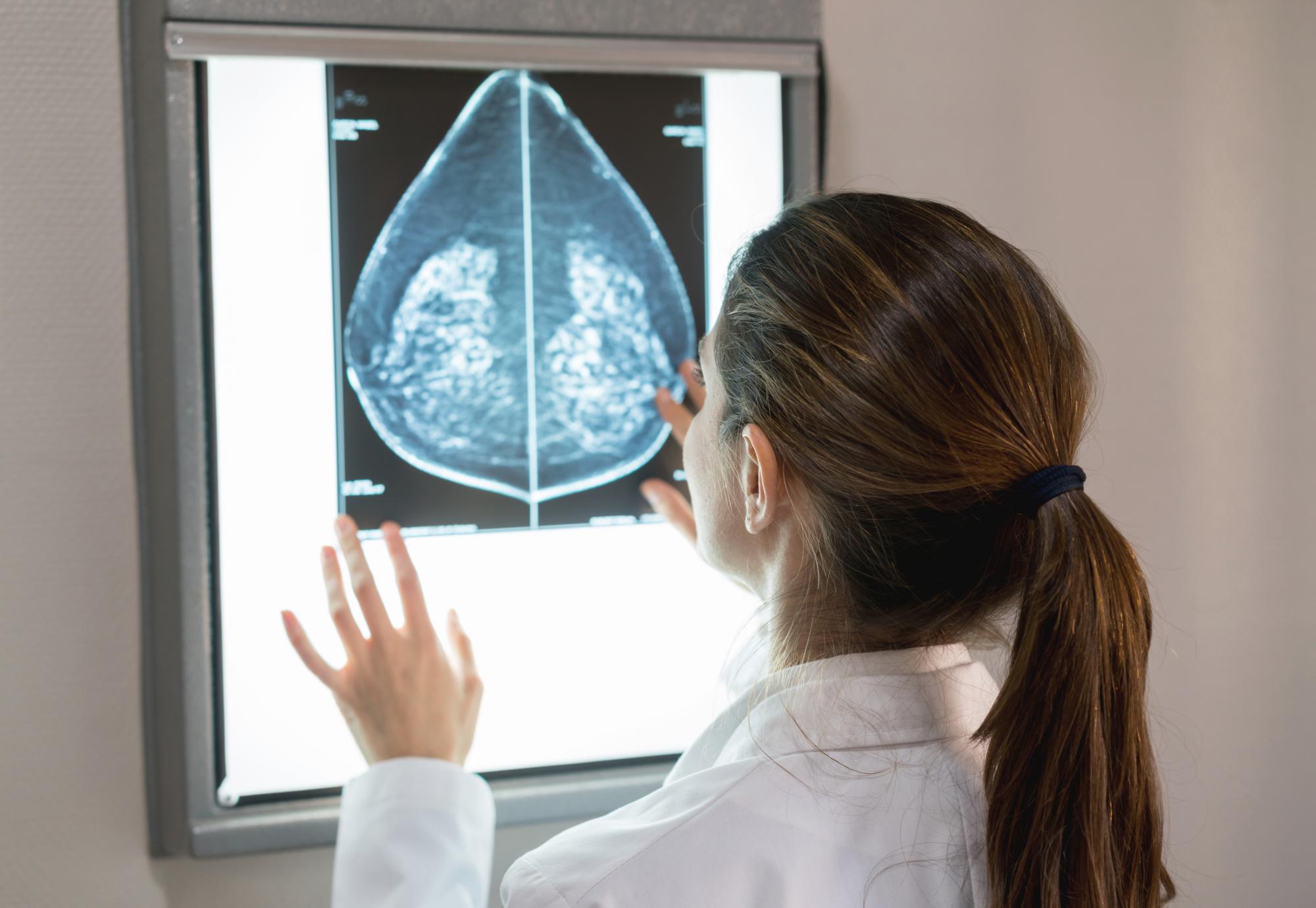 Doctor looking at a mammogram
