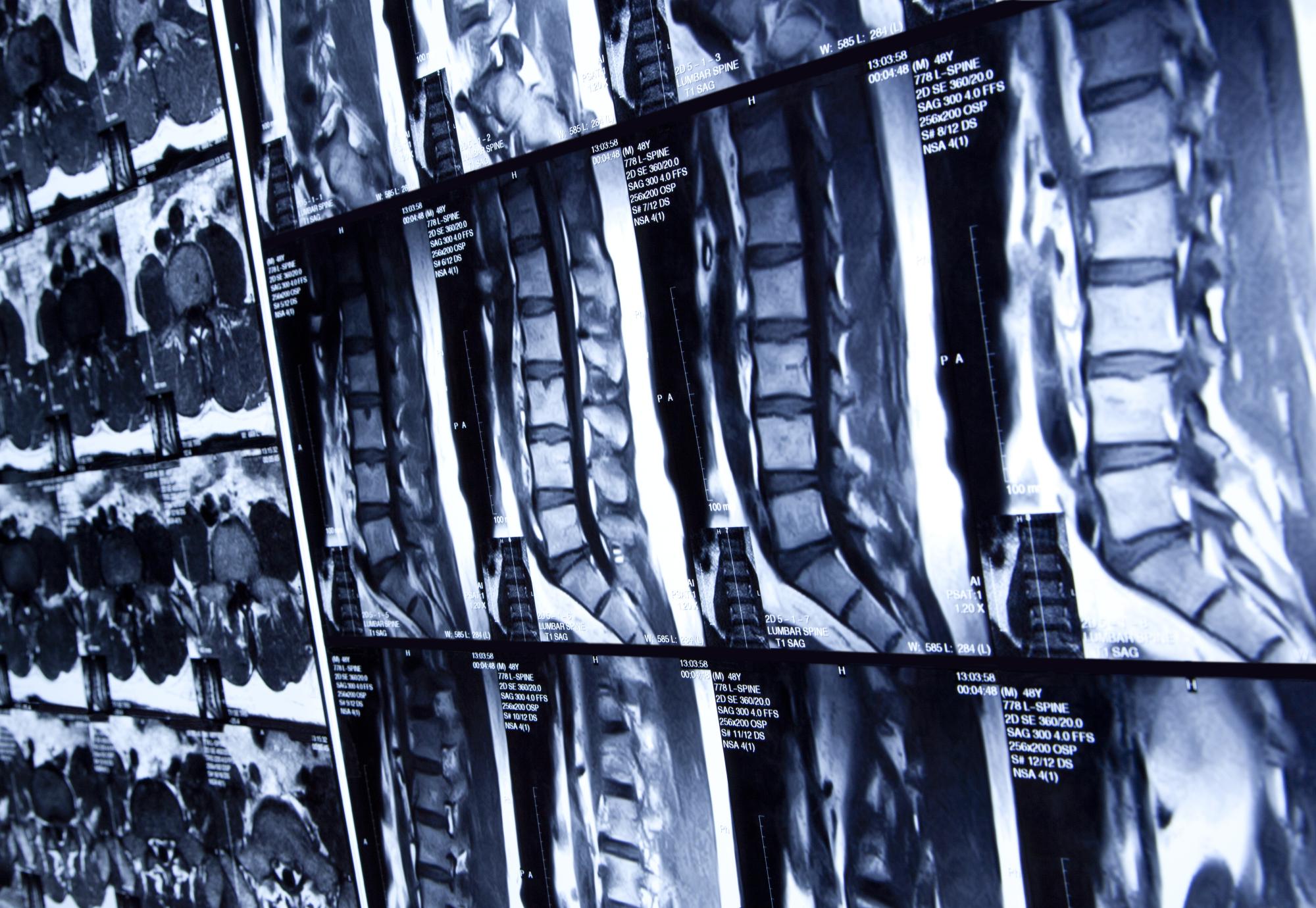 Spine x-ray
