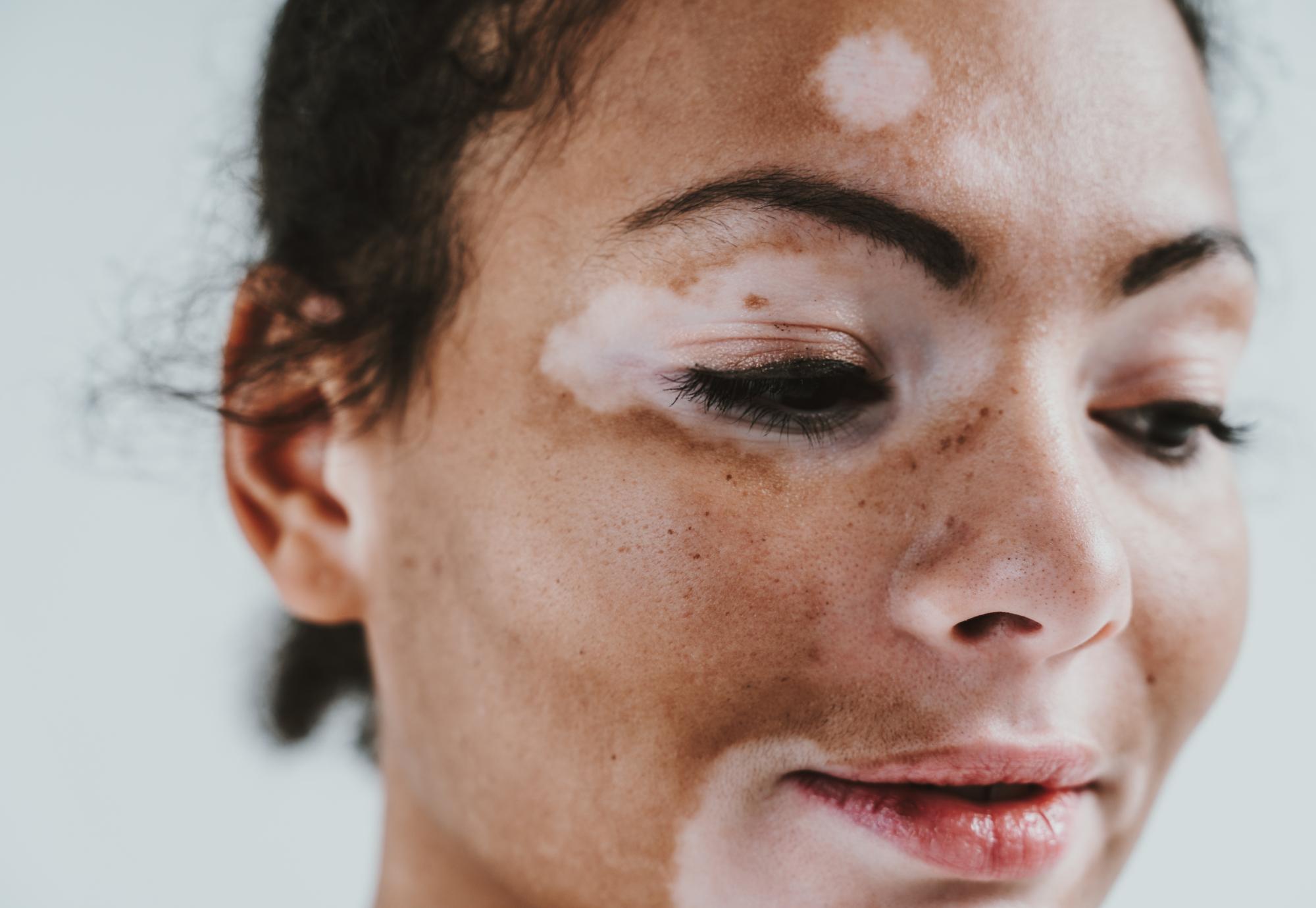 Woman with facial vitiligo