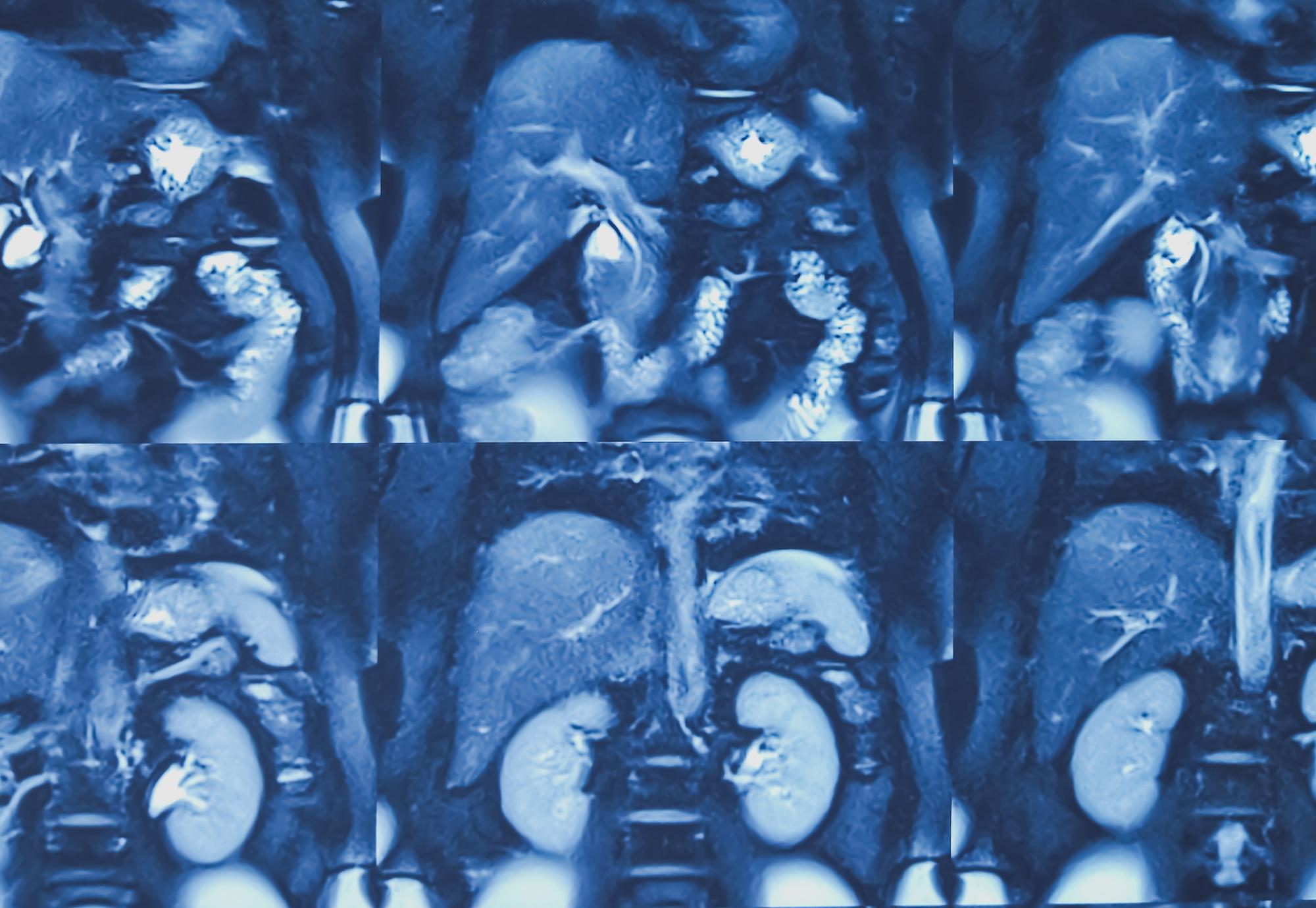 MRI image including bile duct