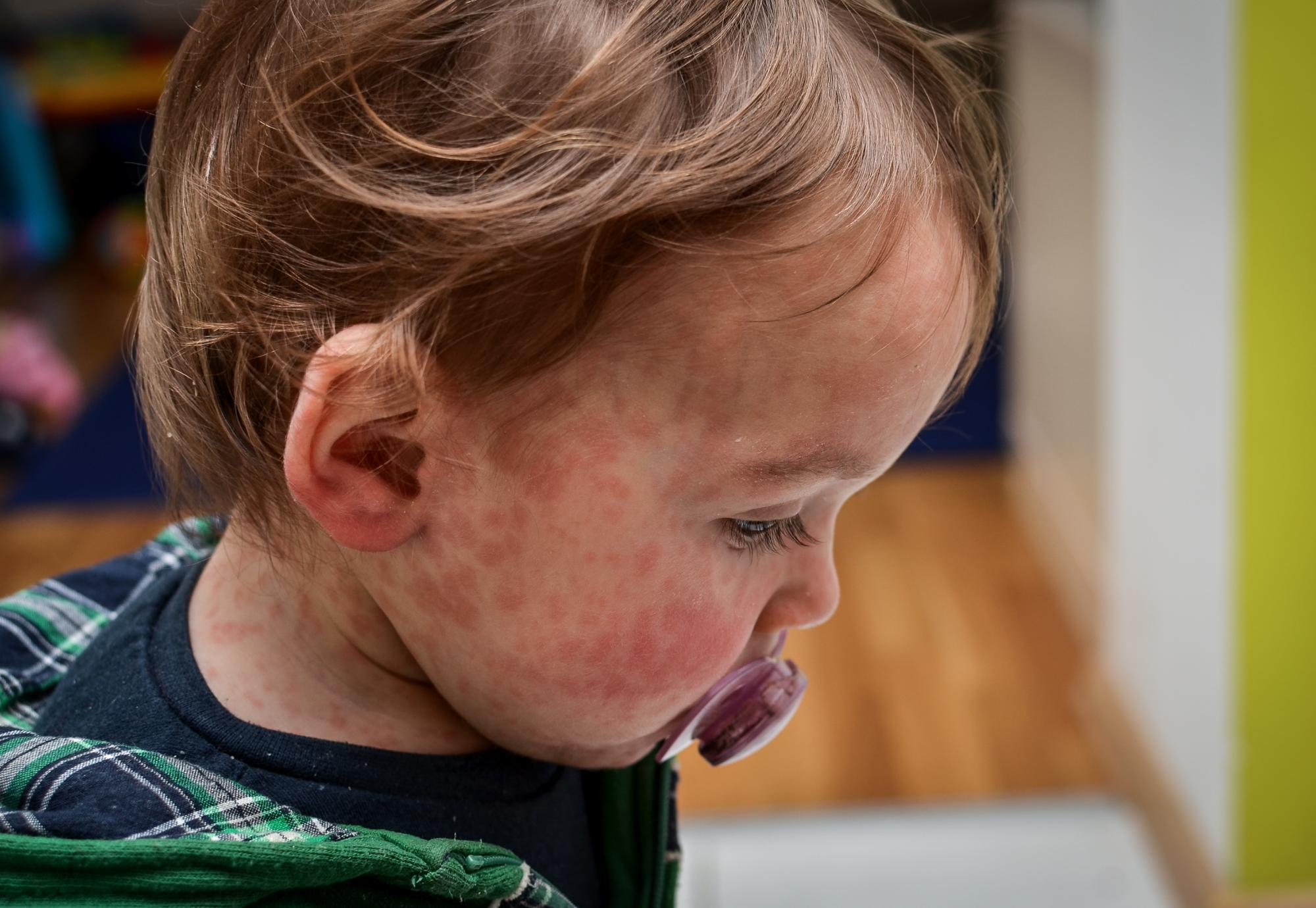 Measles child