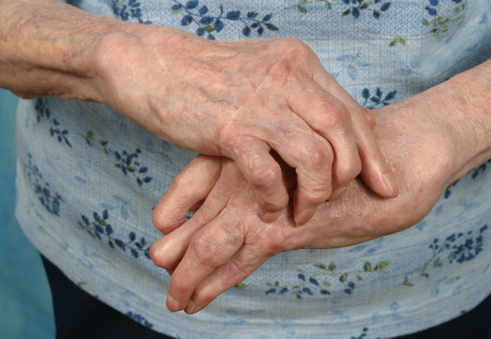 Arthritis
