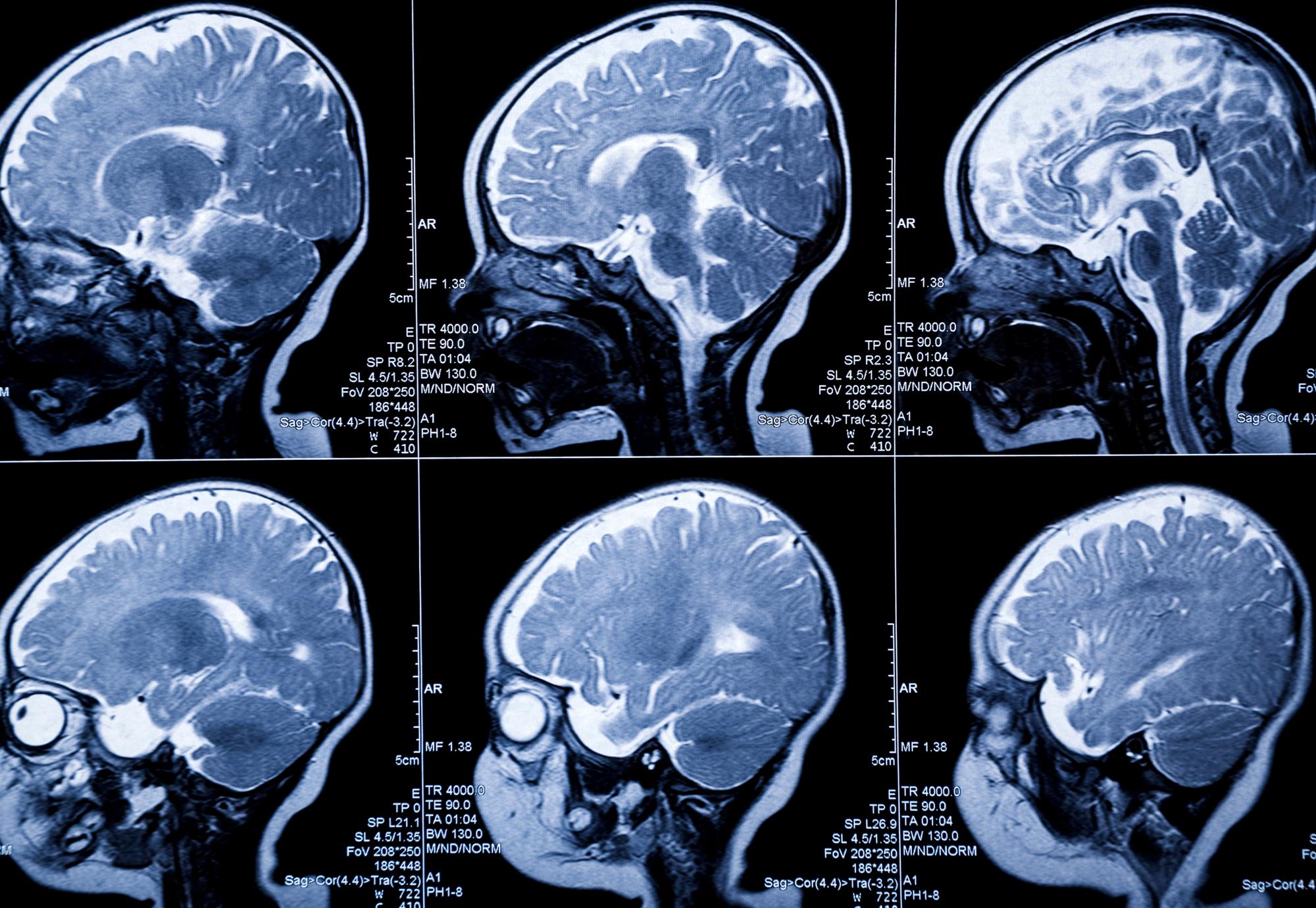 Brain scan