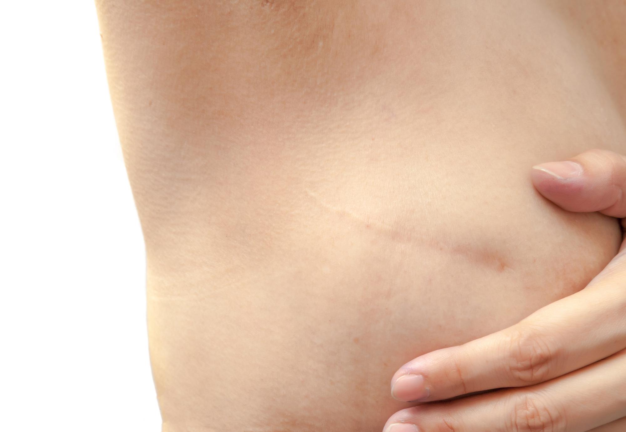 Mastectomy