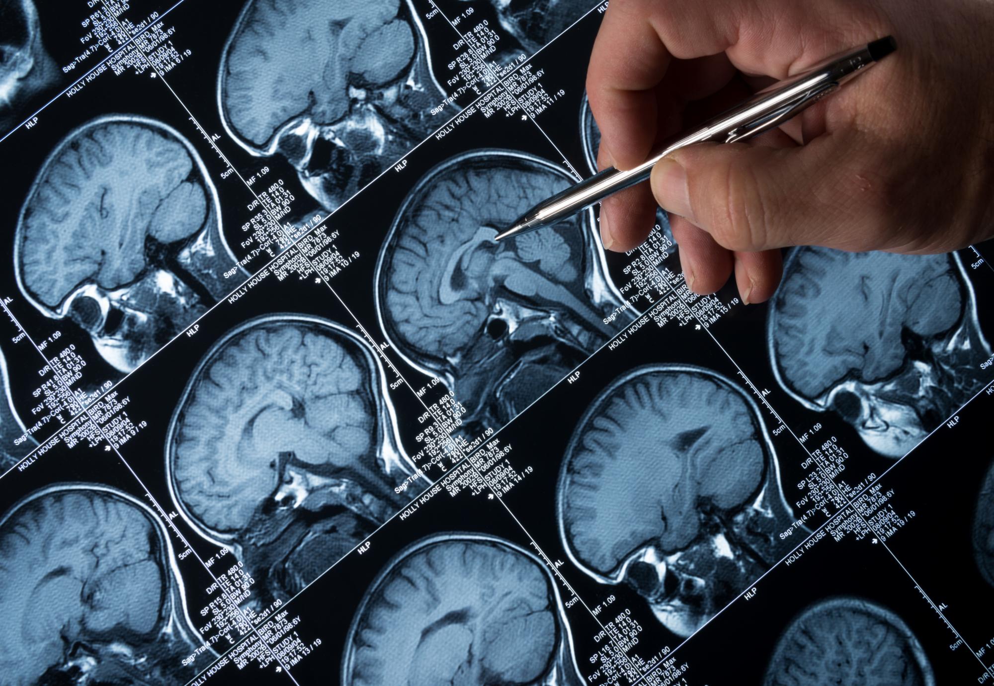 Brain tumour image