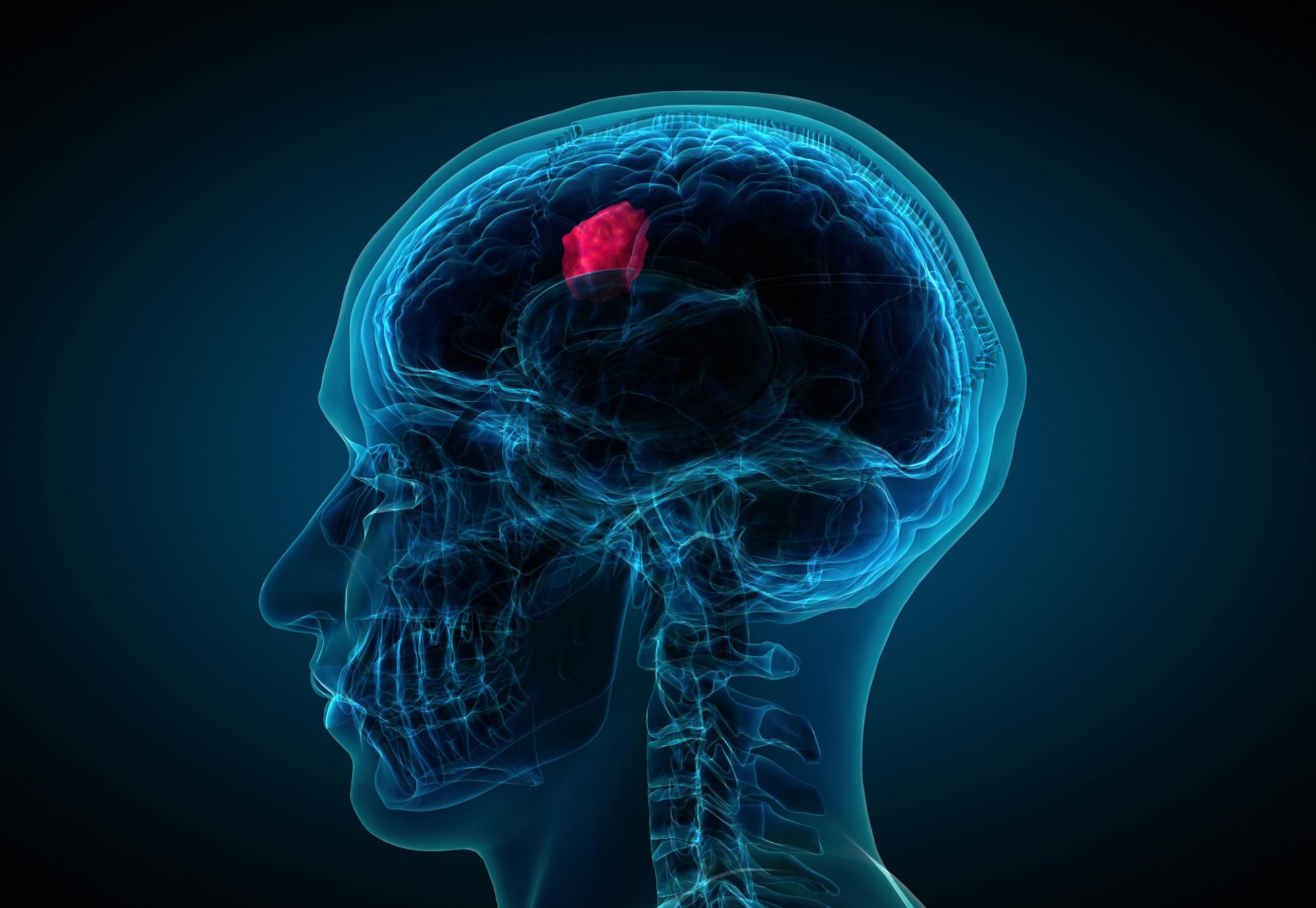 Brain tumour image