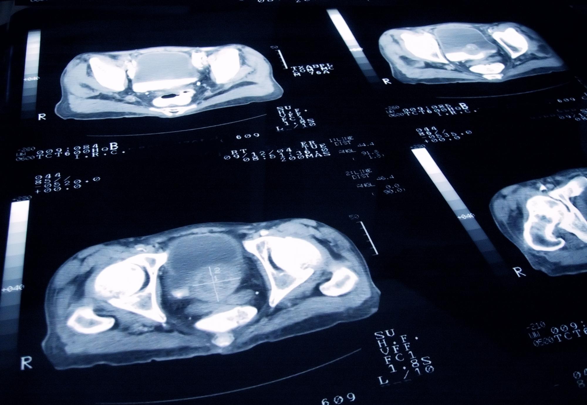 Prostate cancer MRI