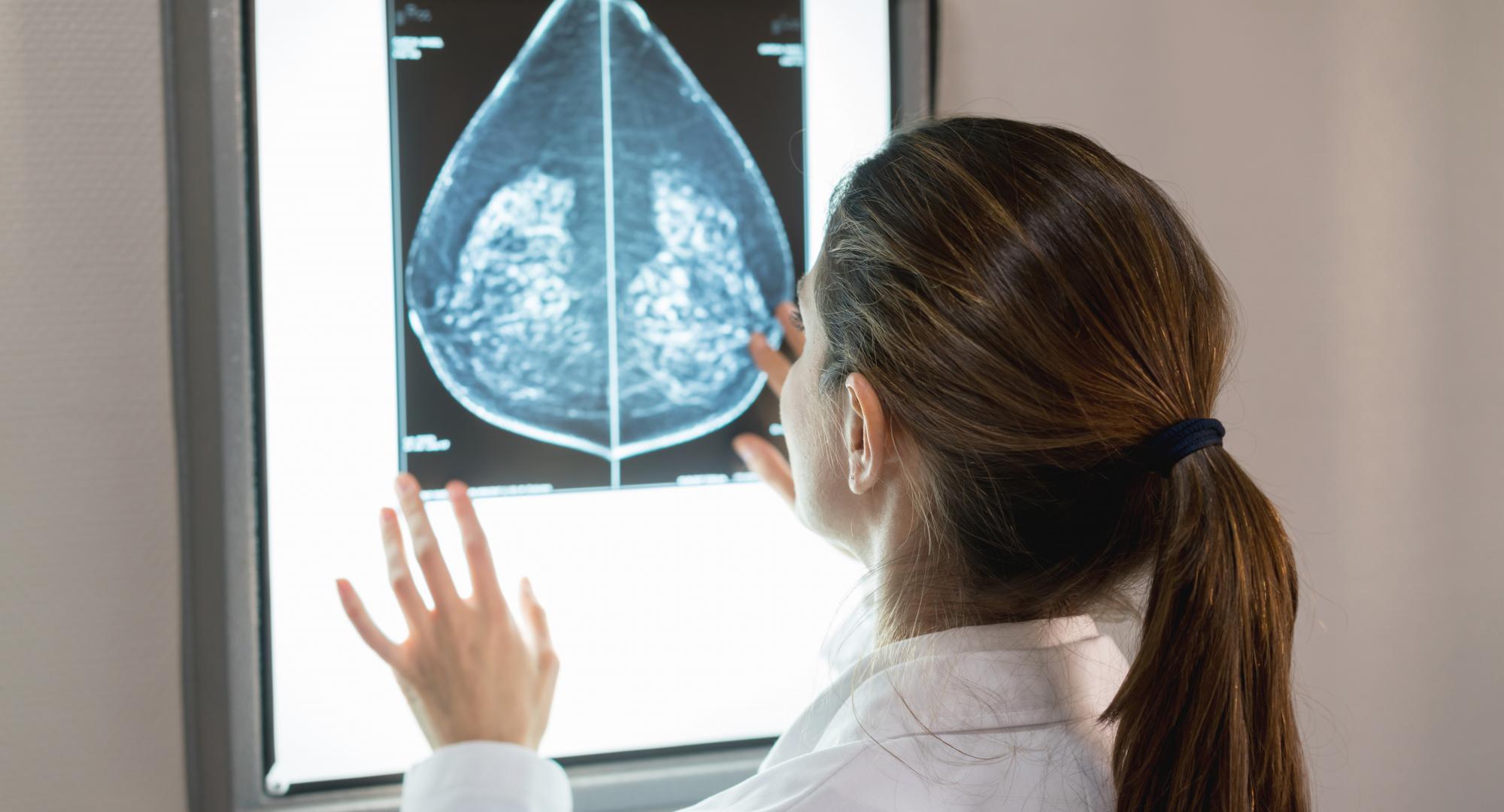 Mammography scanning  - Credit Istock 