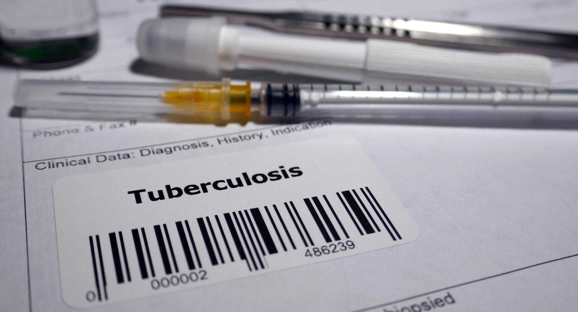 Request for biopsy - Tuberculosis