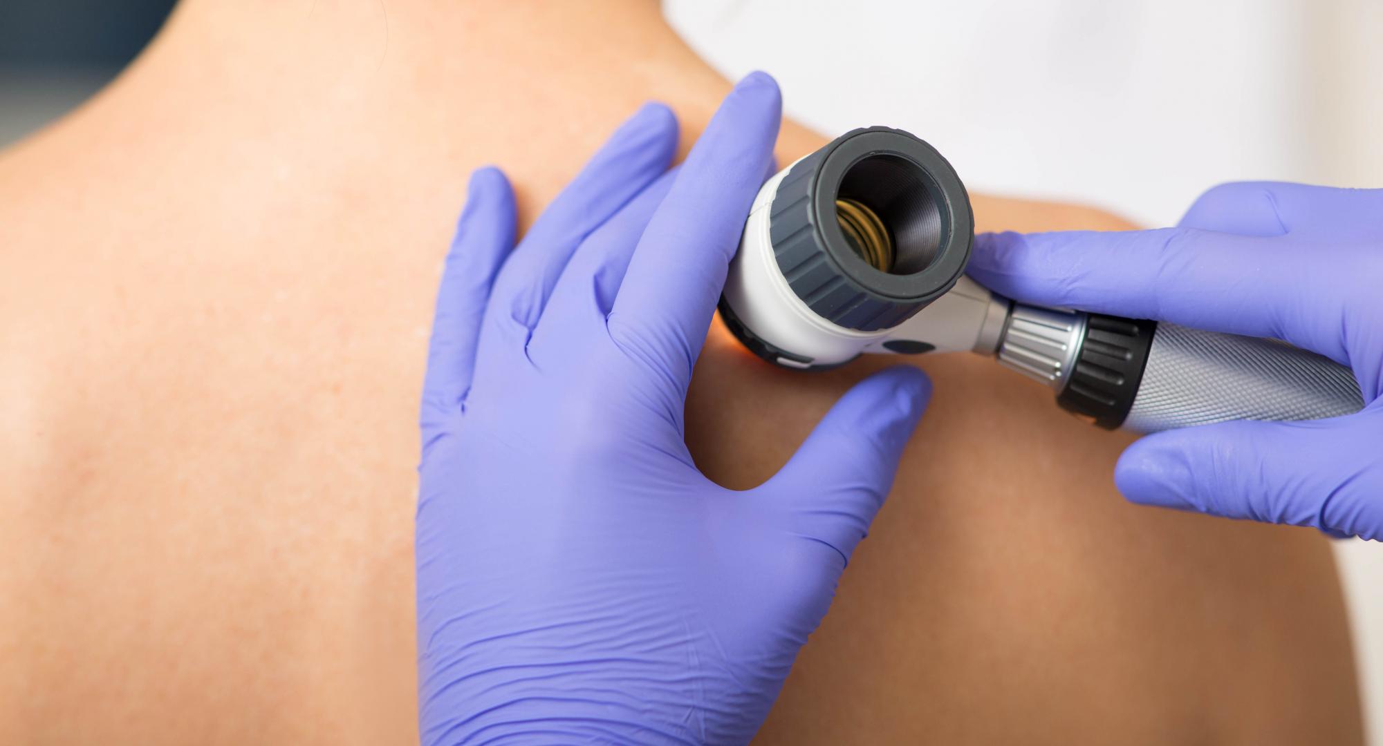 Dermatologist Inspecting patient skin moles