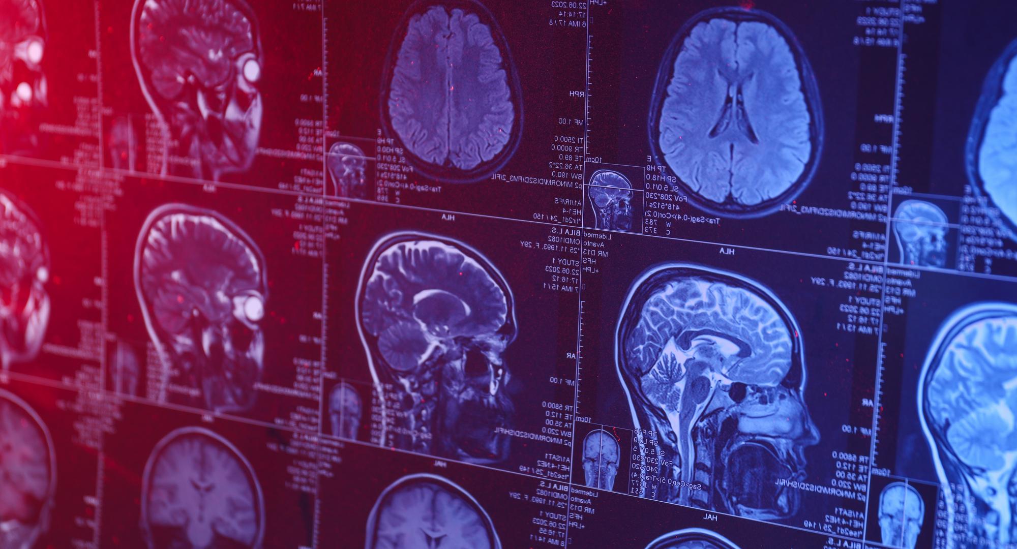 MRI scan of brain