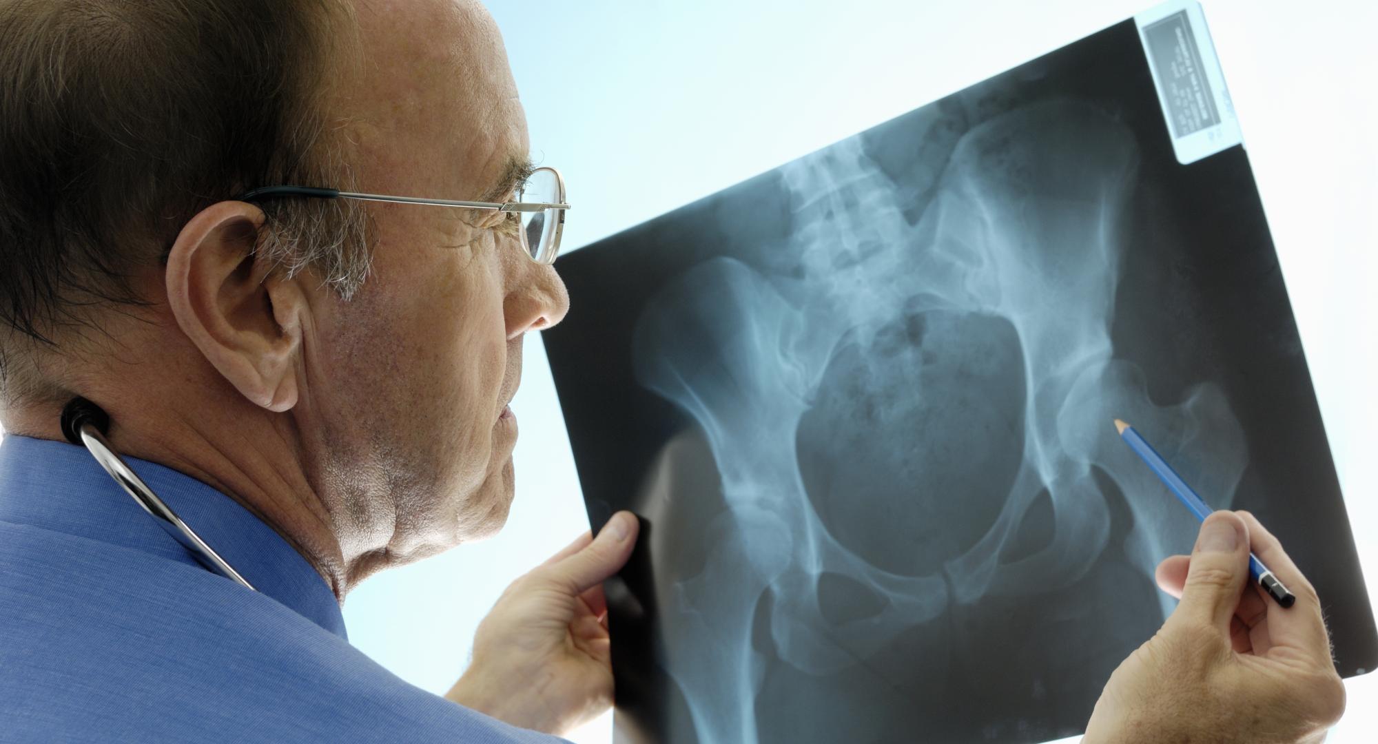 X-ray of someone's bones