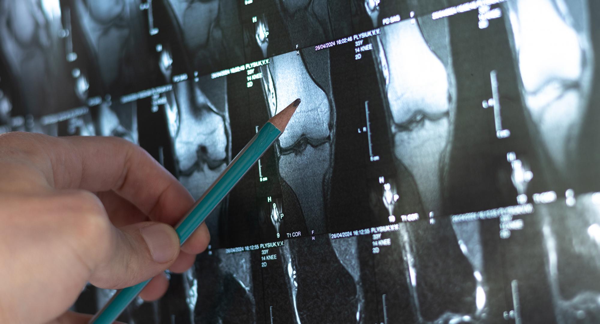 Doctor examining bone tumour