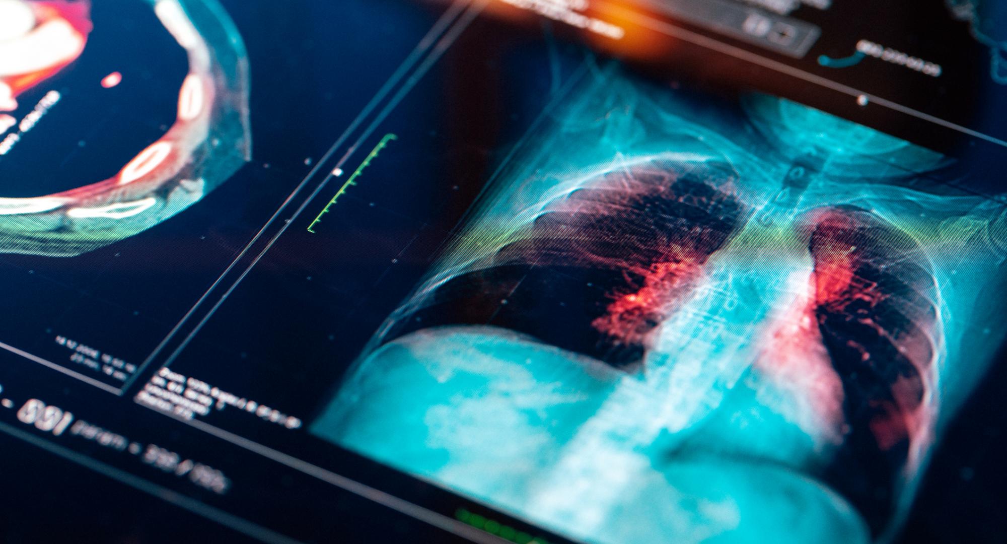 Lung MRI
