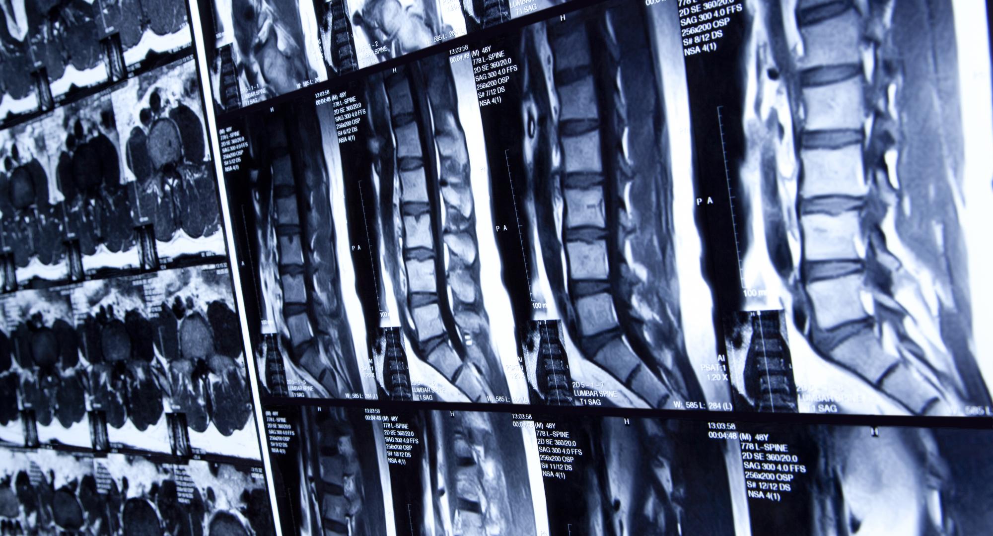 Spine x-ray