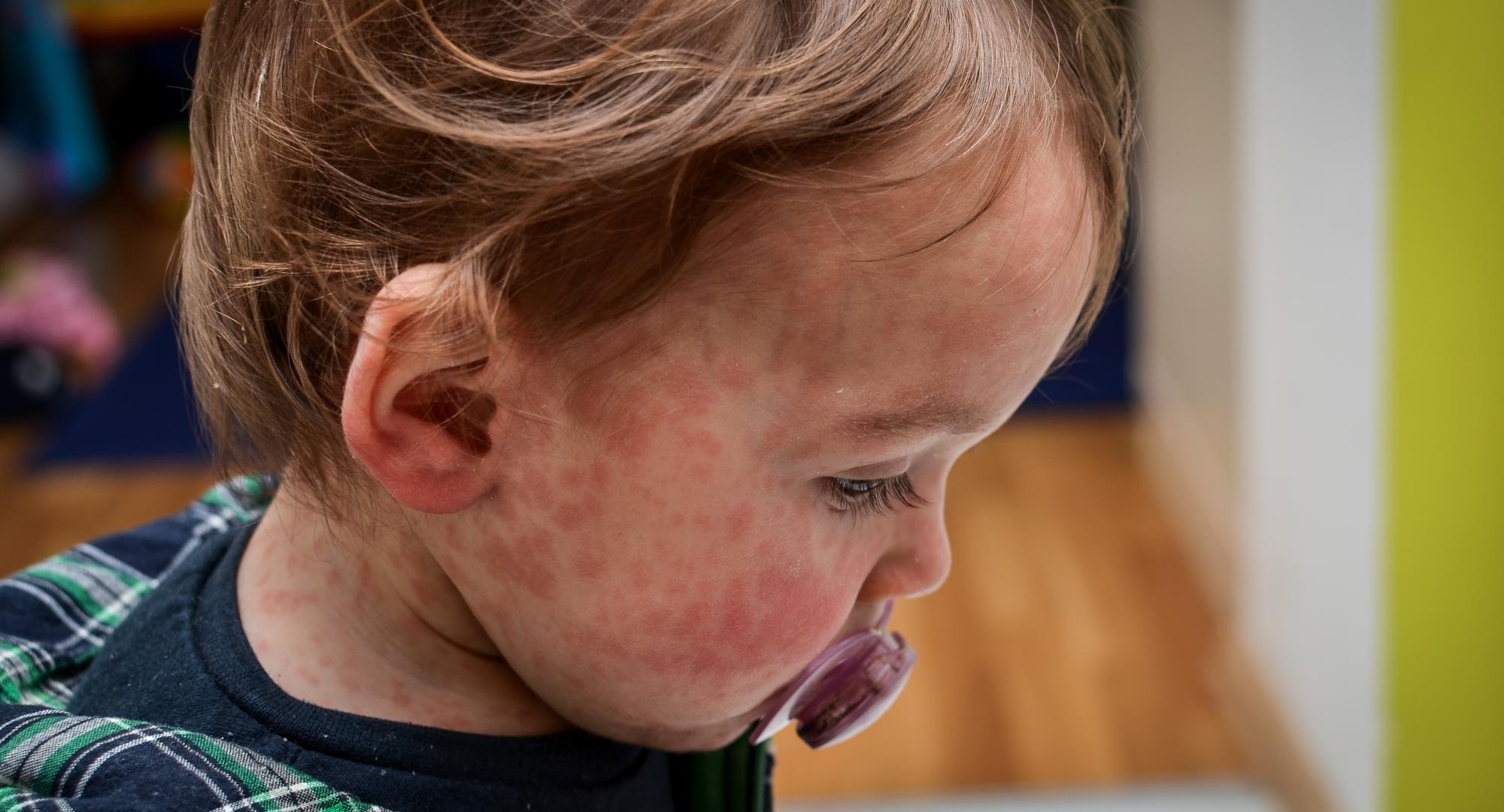 Measles child