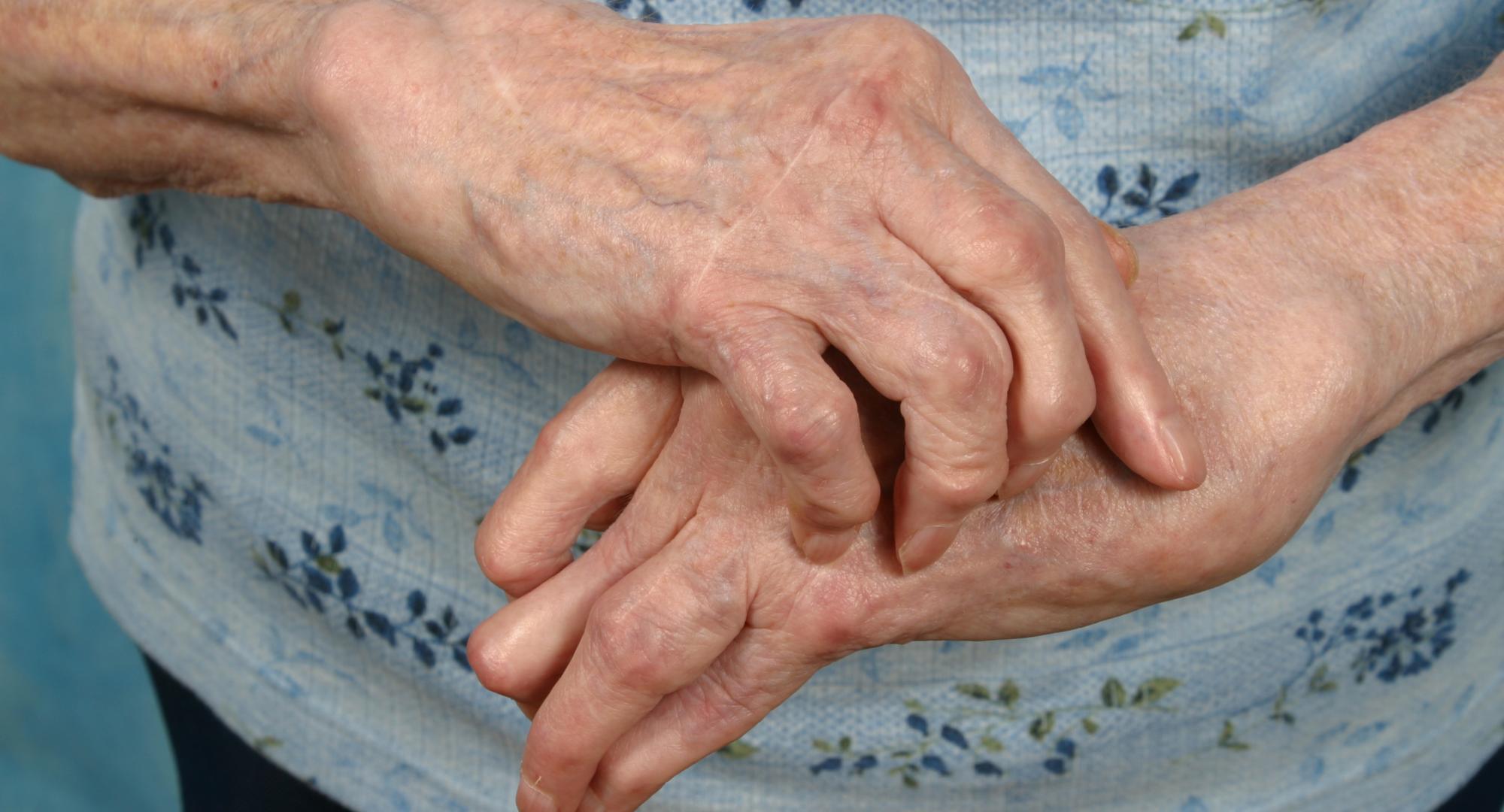 Arthritis
