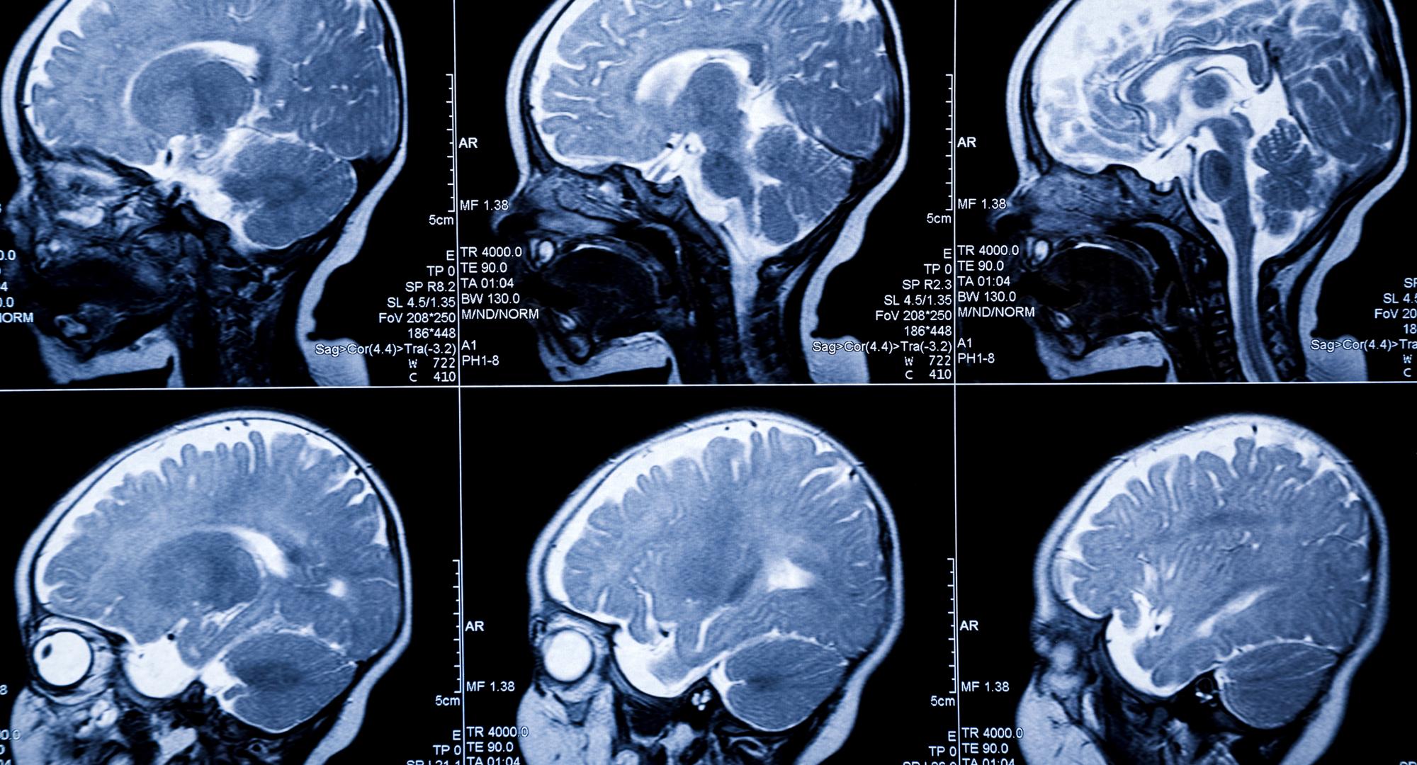 Brain scan