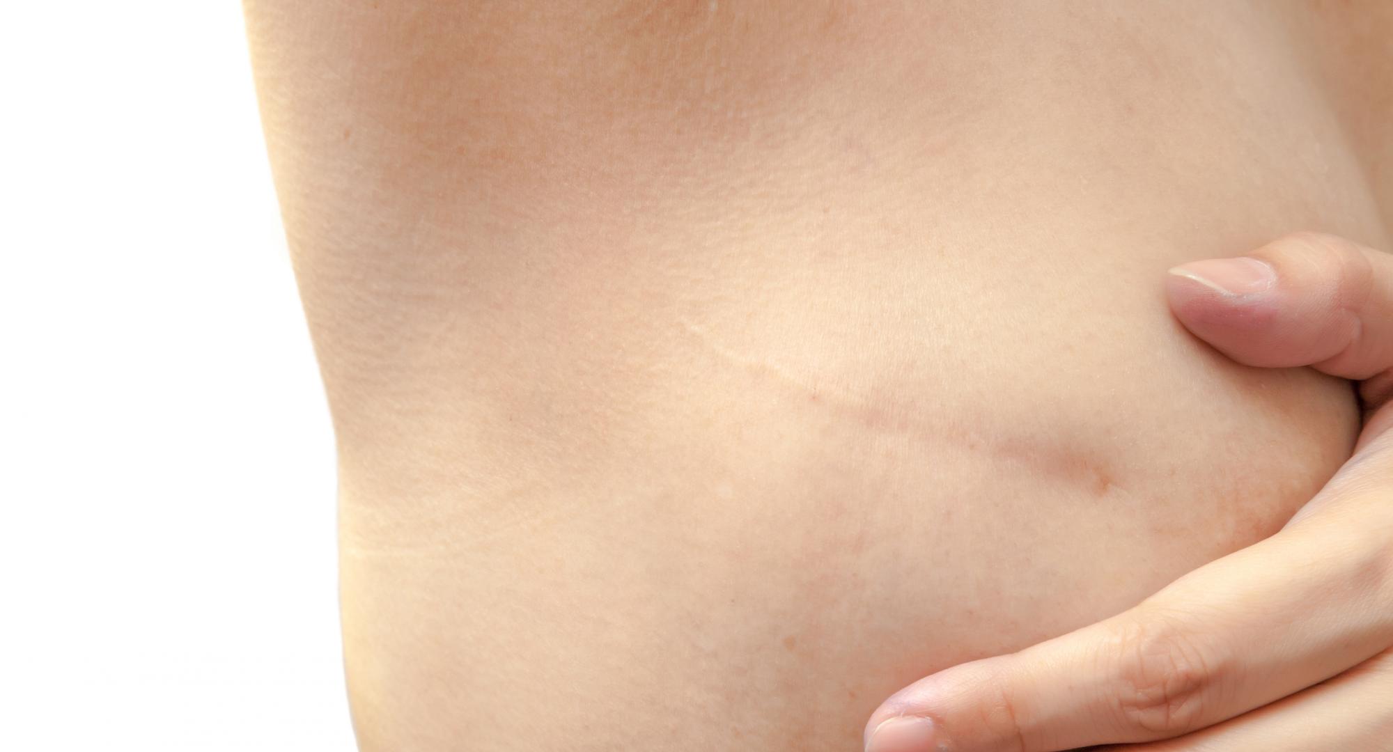 Mastectomy