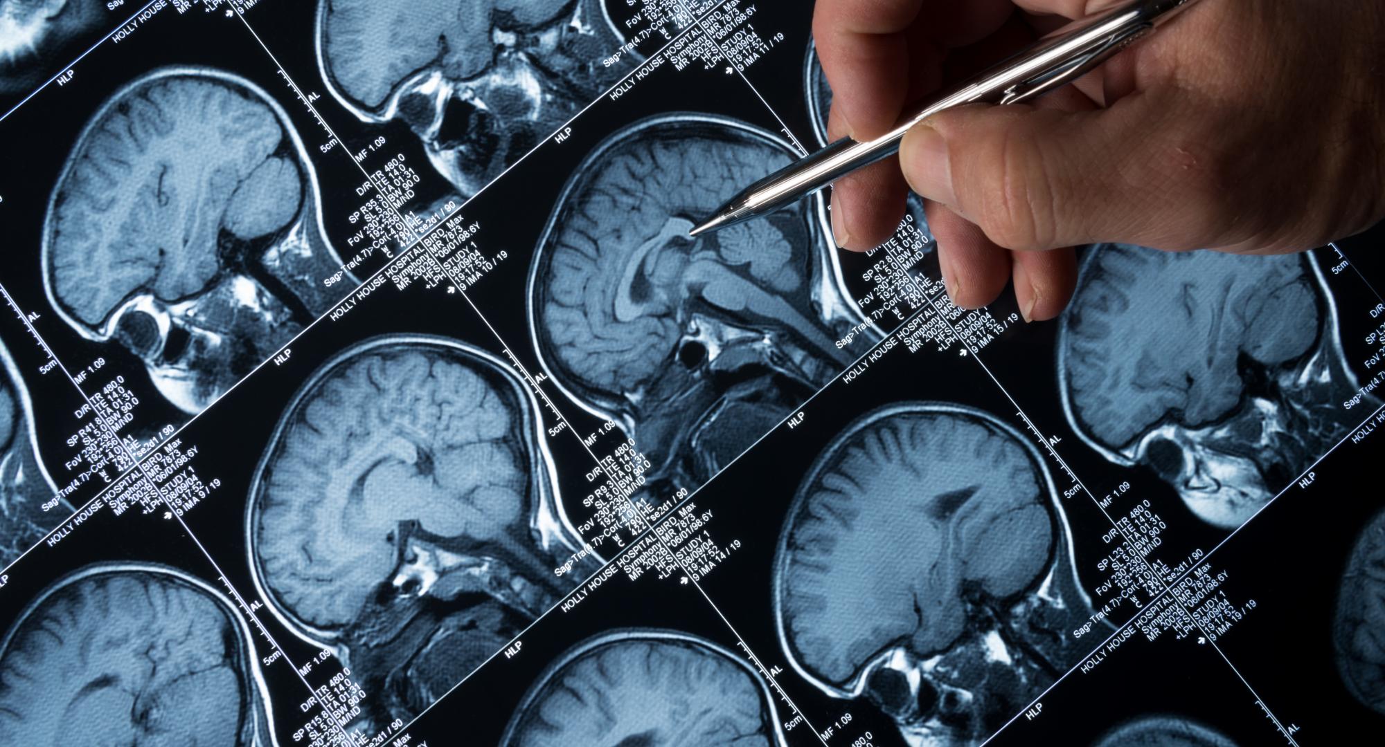 Brain tumour image