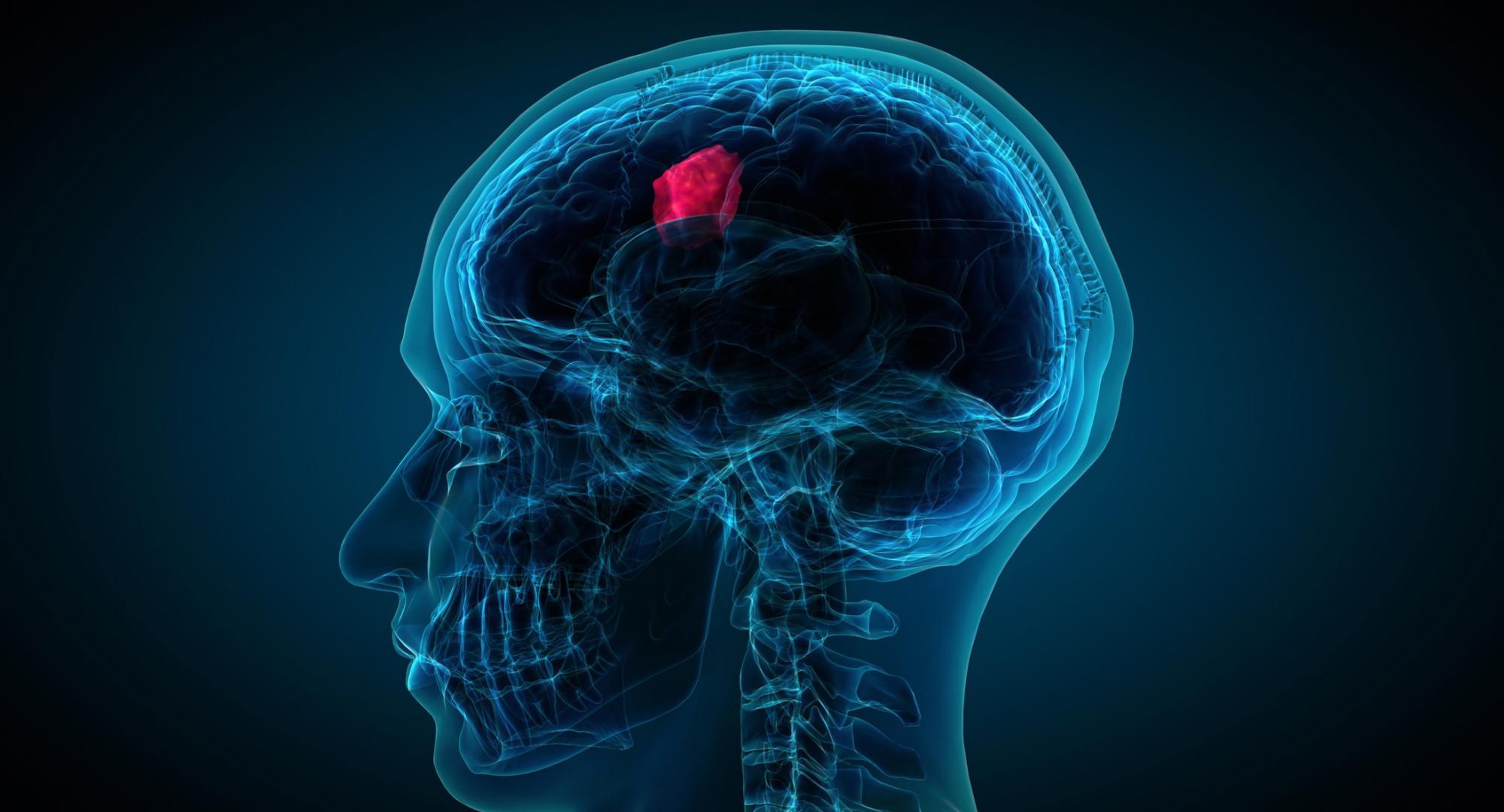 Brain tumour image