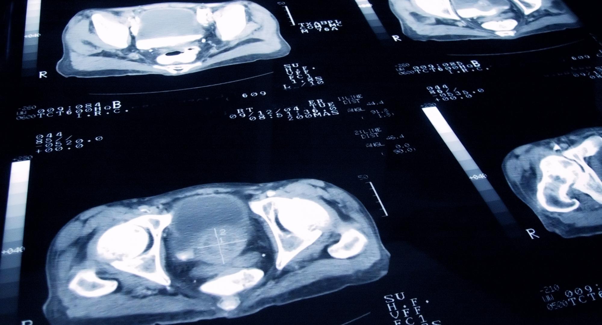 Prostate cancer MRI