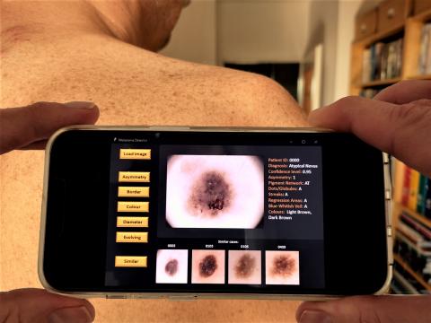 Melanoma app