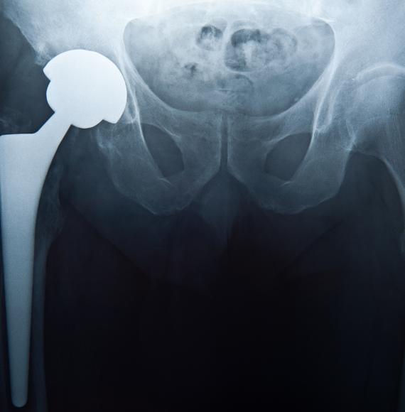 Hip replacement x-ray