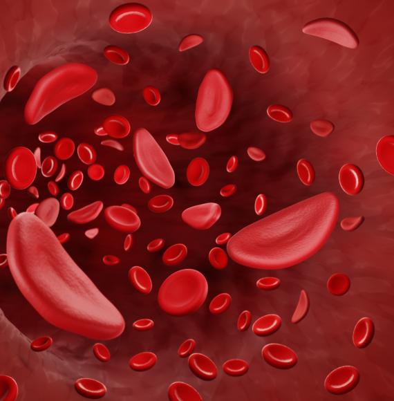 Artist illustration of sickle cell disease